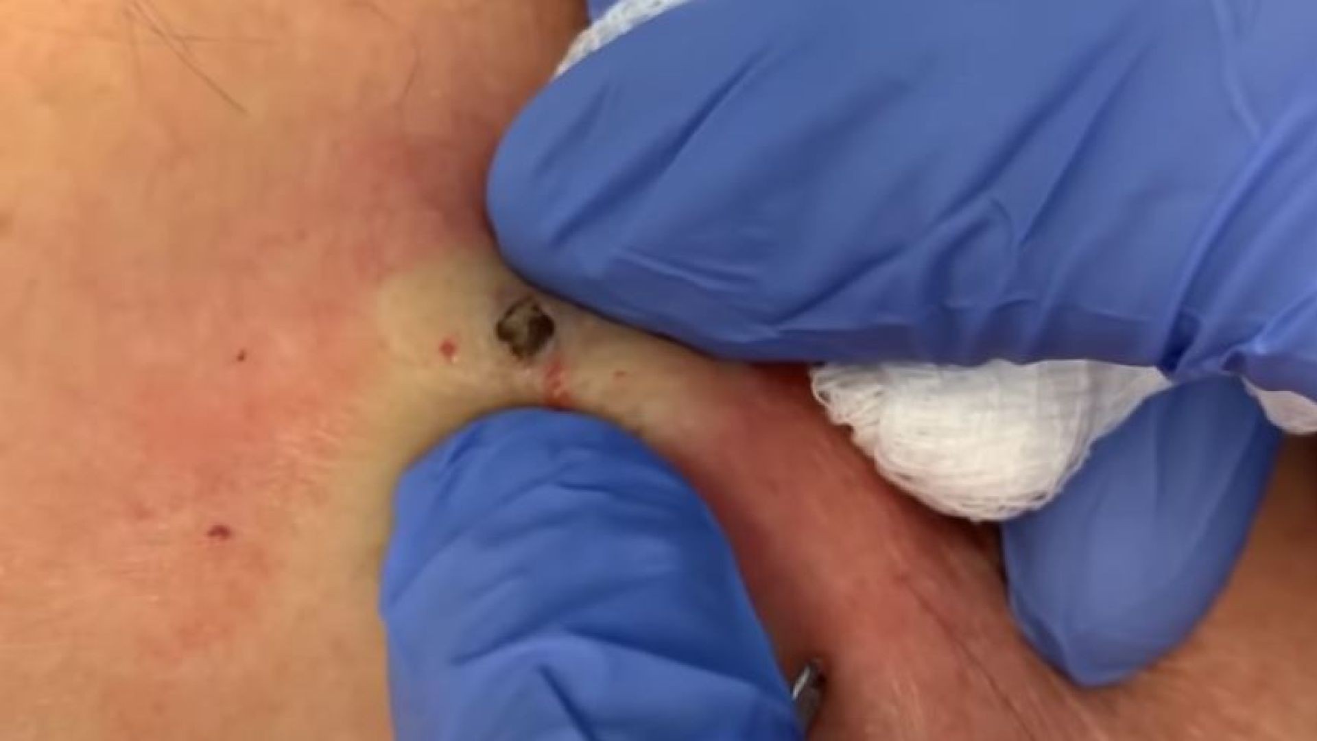 Blackhead (Jelly Bean) Extraction From Behind the Neck