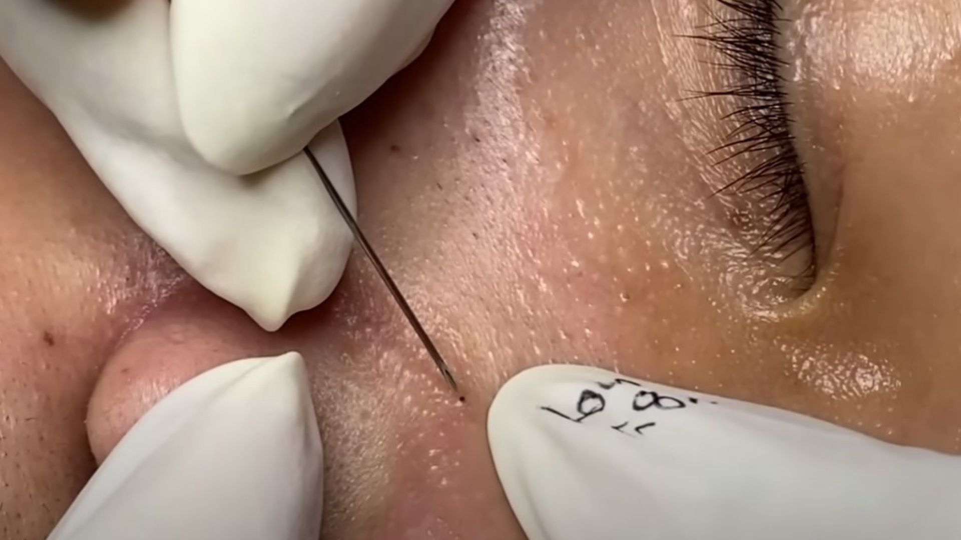 Loan nguyen pimple