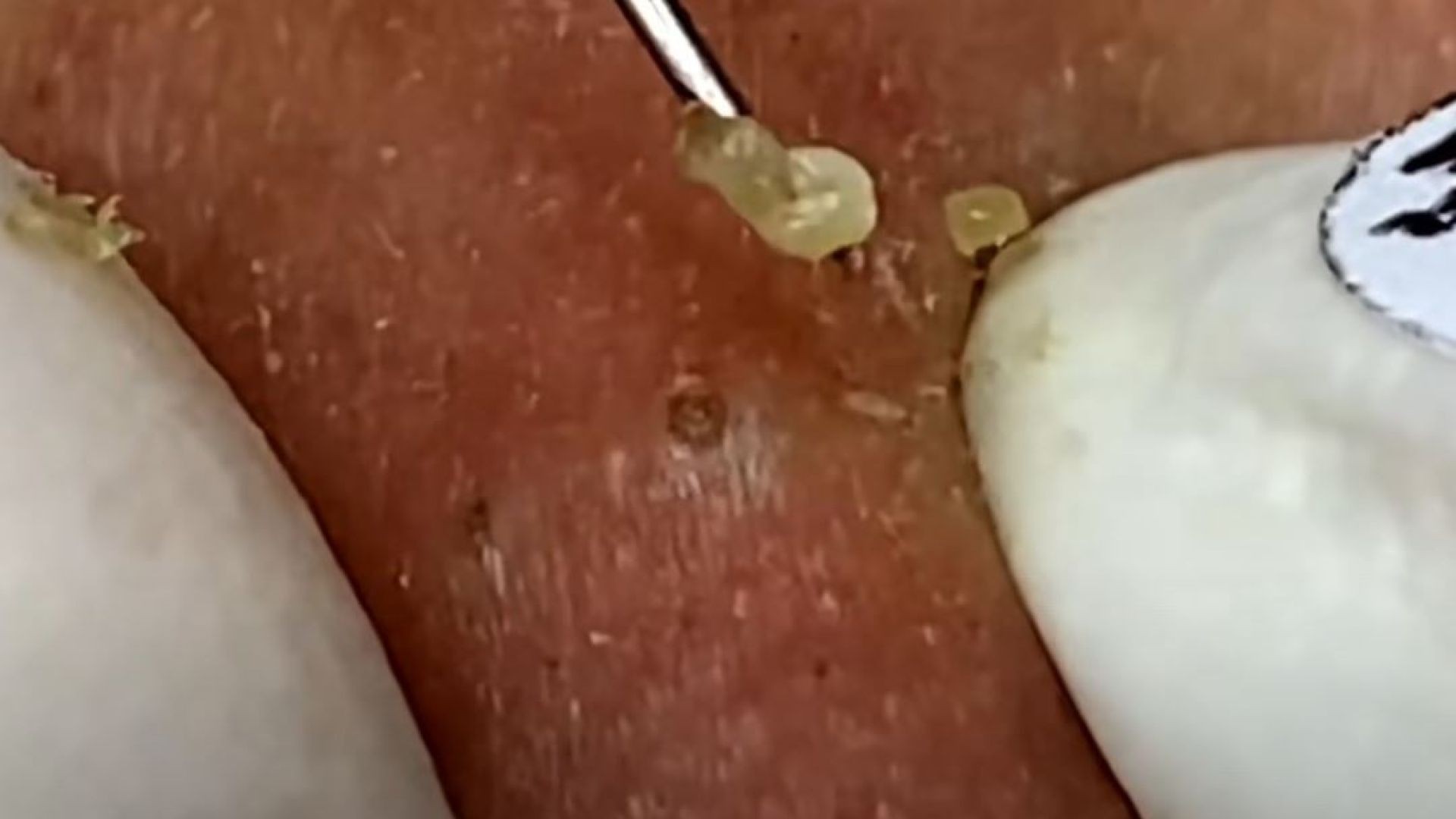 Pimples, Whiteheads and Blackheads Galore