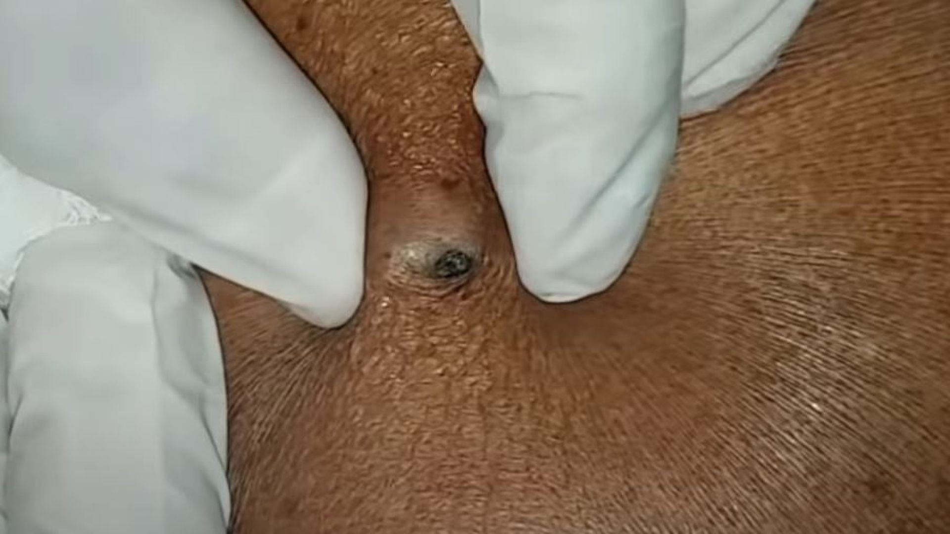 DILATED PORE OF WINER | HUGE BLACK HEAD FROM CYST