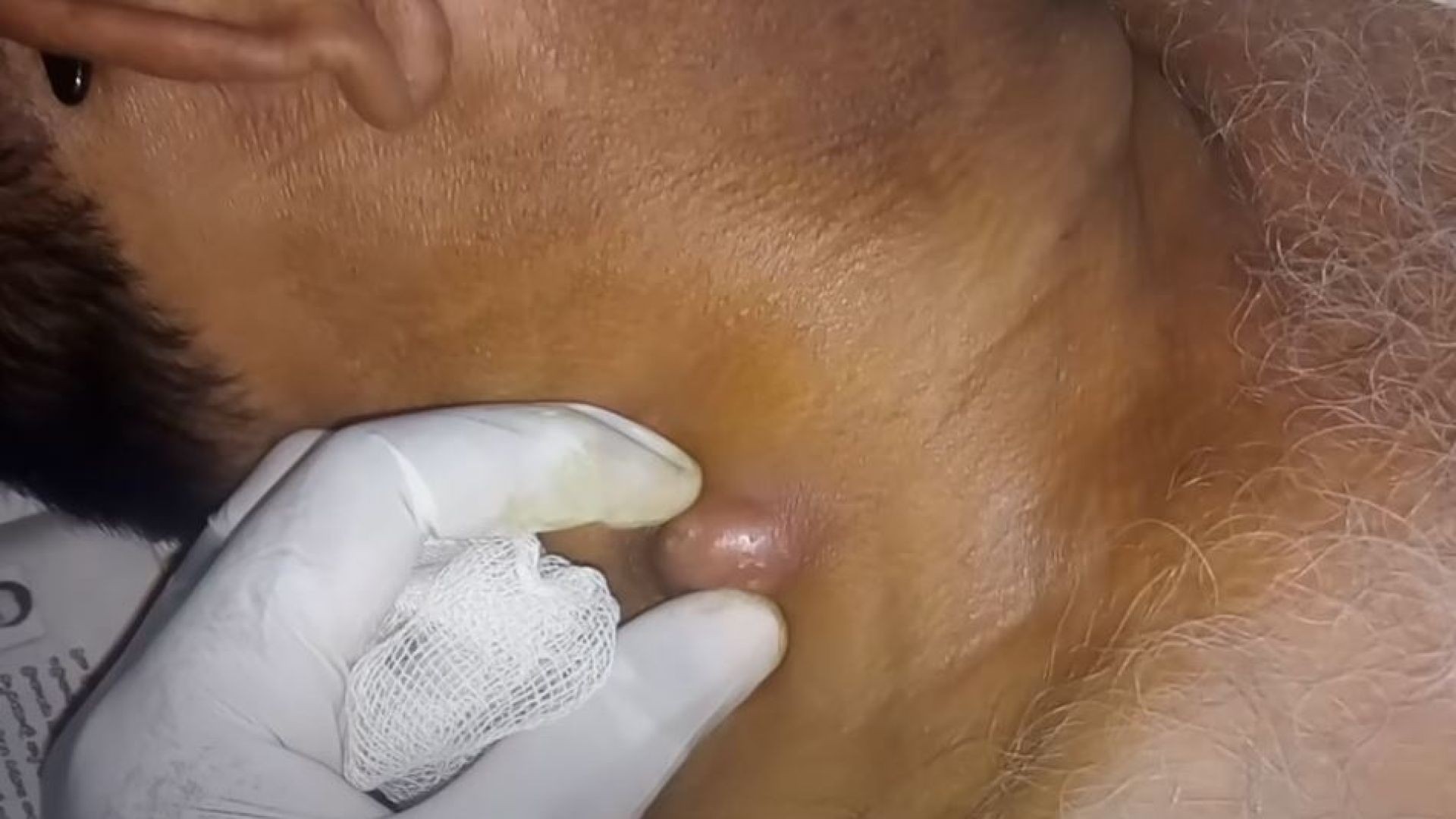 Abscess at the neck with huge huge pus popping out. A million view video is here