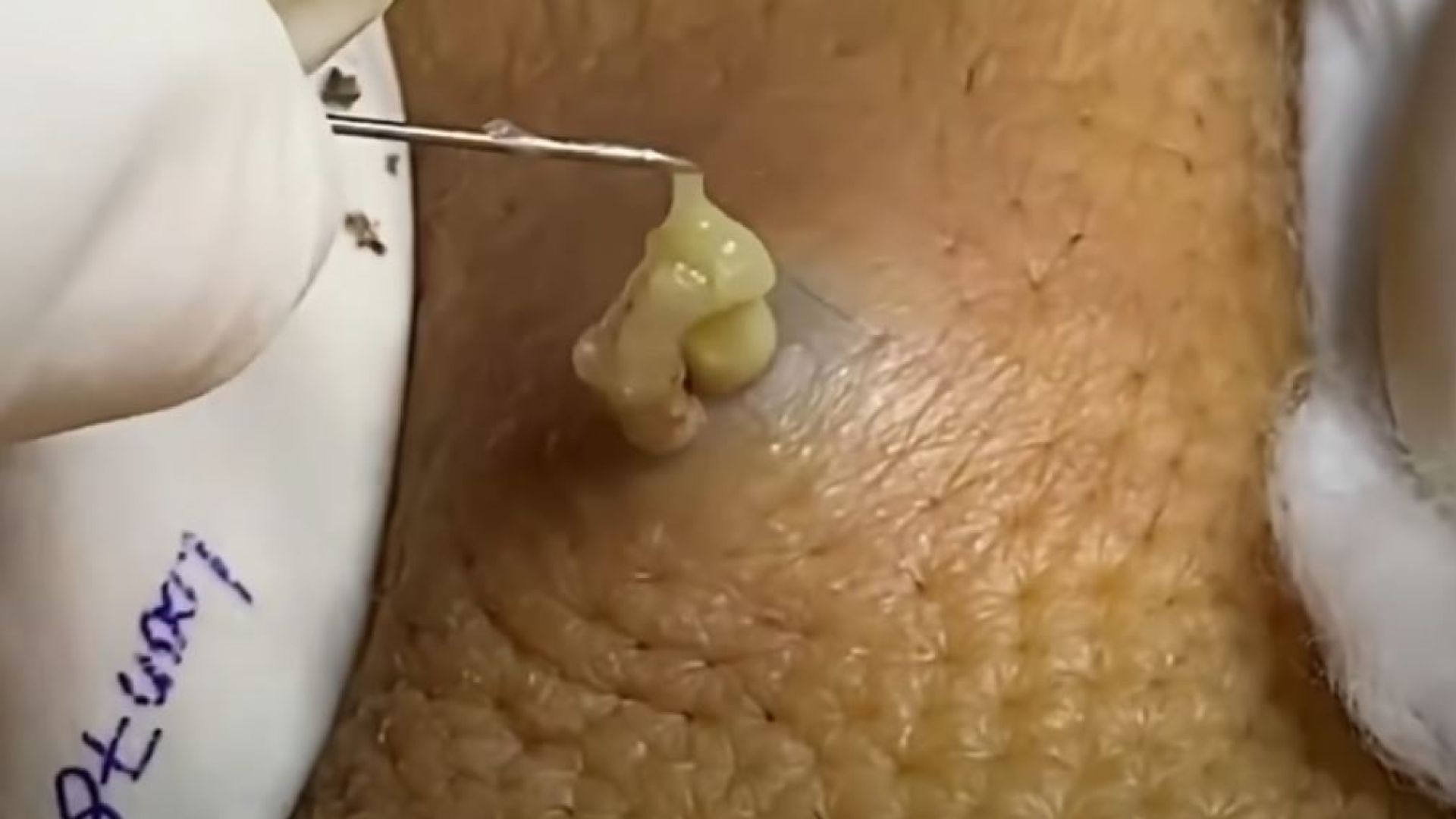 Cyst compilations
