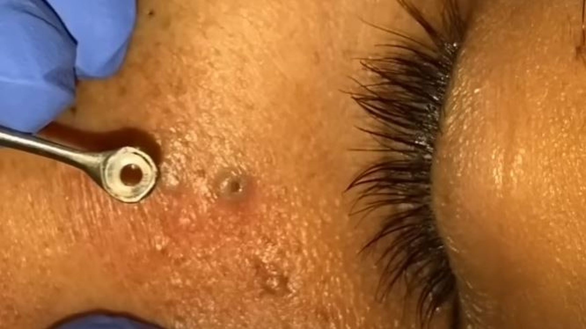 Blackheads Removal Full Video by Dr Lalit Kasana