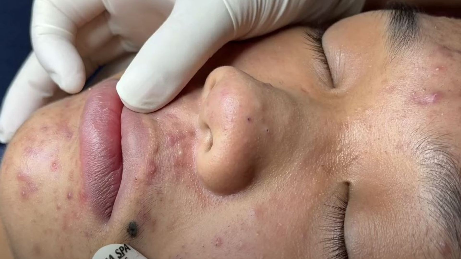 Remove Blackheads Around Mouth And On Cheeks