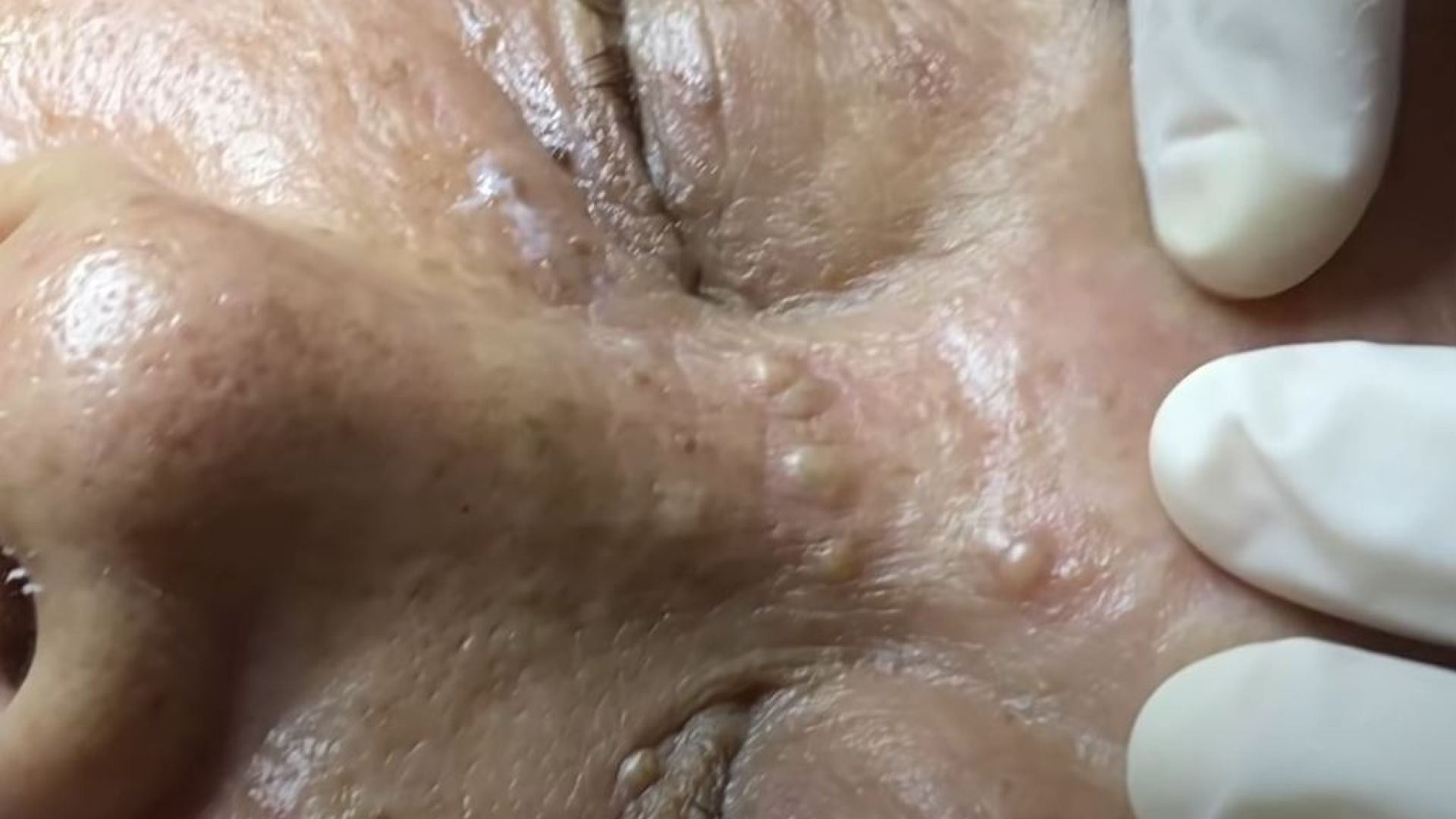 Treatment Of Blackheads And Hidden Acne #047