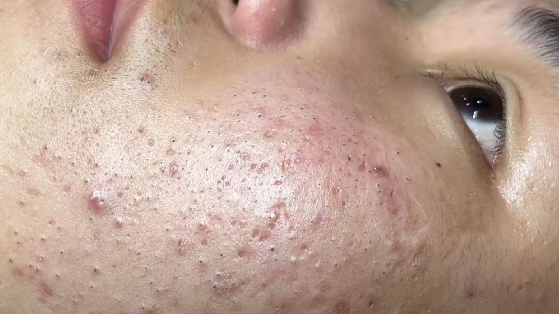 Treating Blackheads And Acne Hidden In The Nose