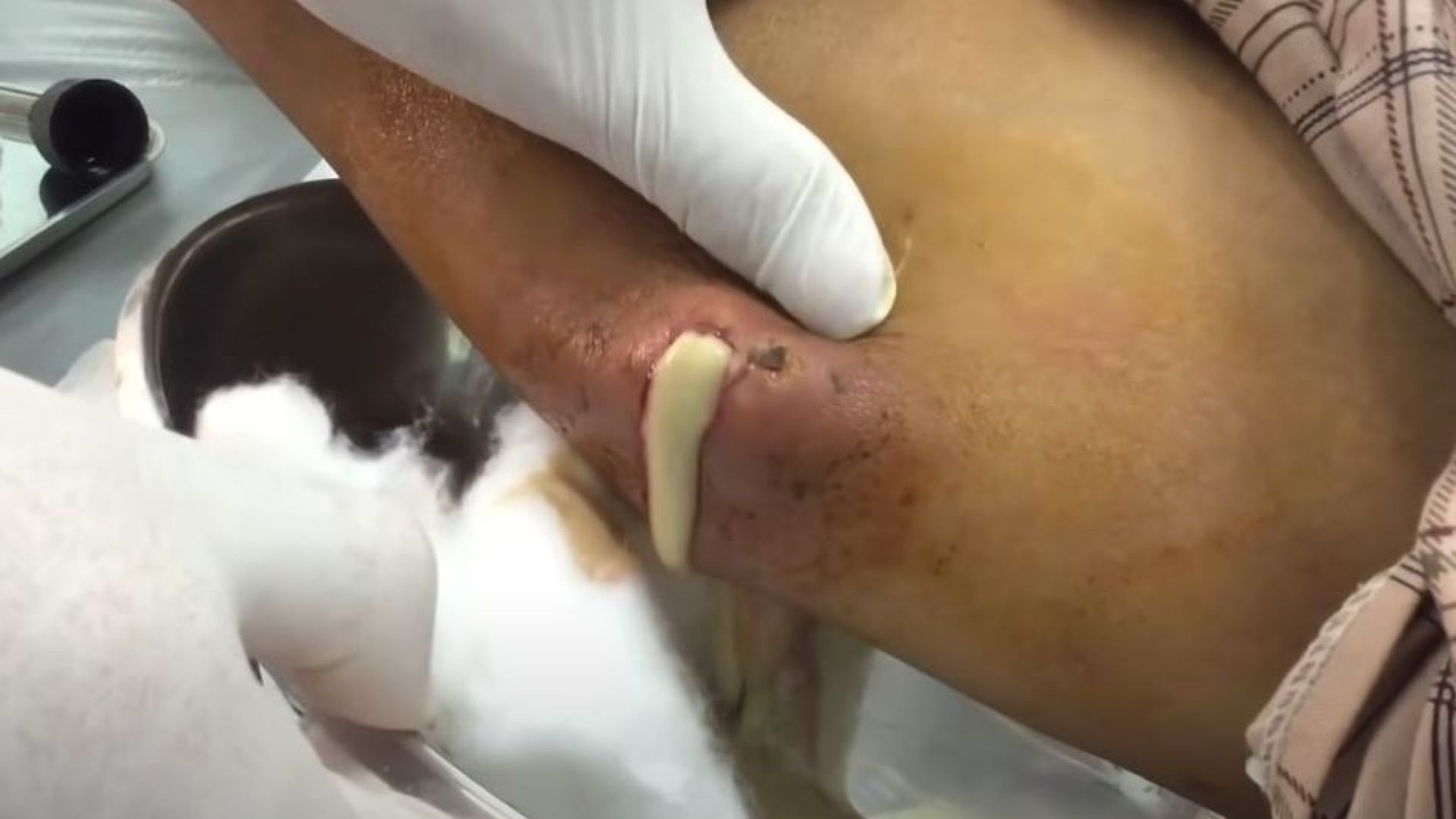 Cyst exploding on knee