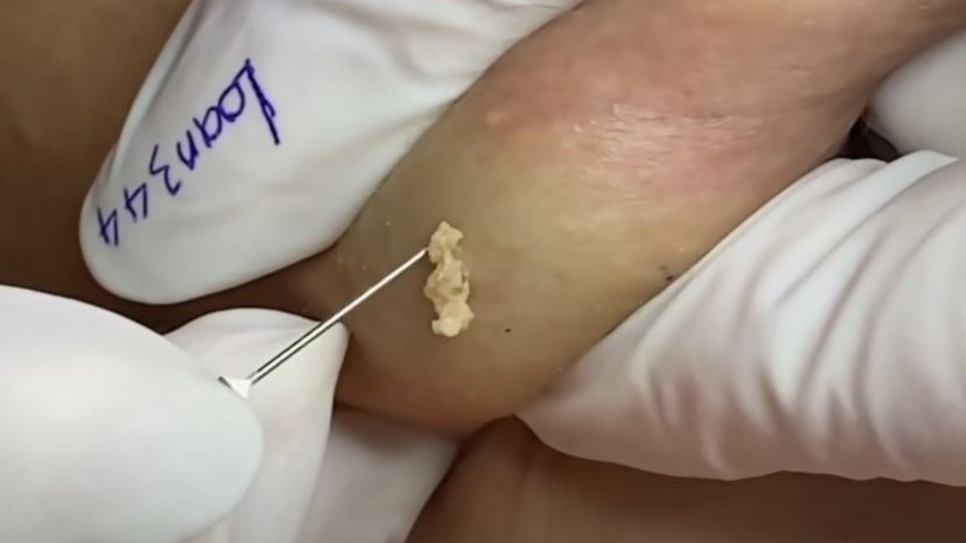 Remove big CYST and SUC 20 years (344) | Loan nguyen