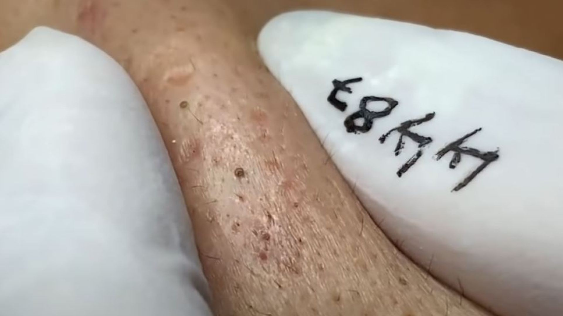Blackheads Treatment with Loan