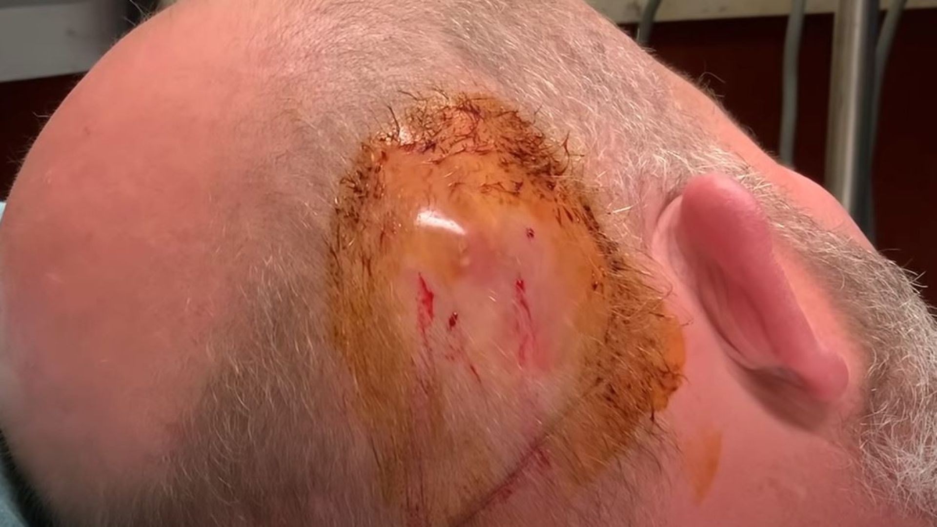 Large scalp infection