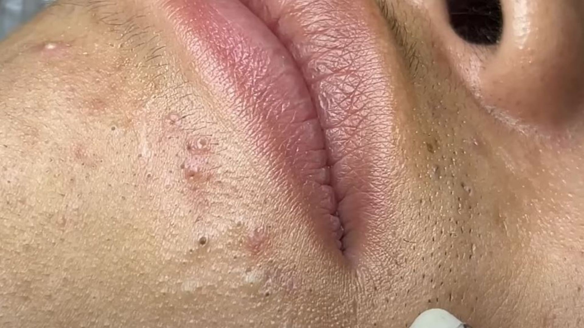 Treatment Of Blackheads And Hidden Acne  #025