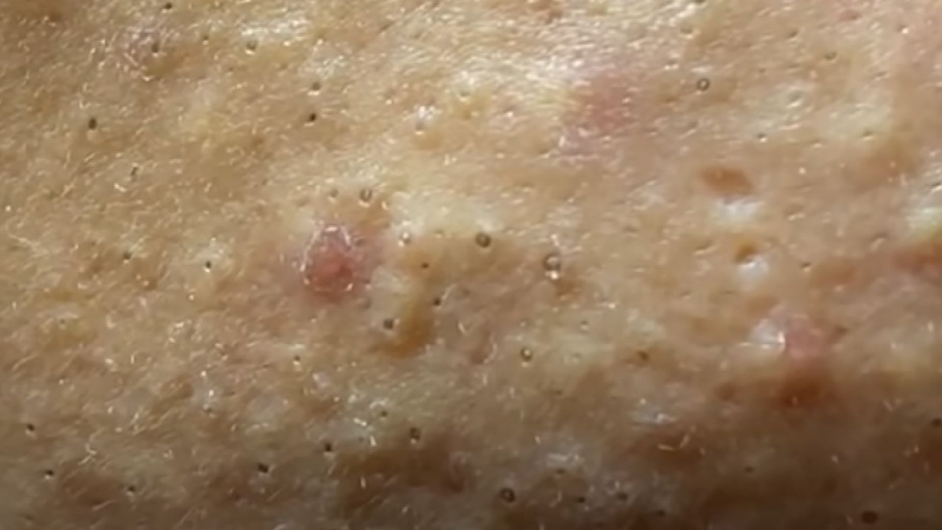 Big Acne "Thao P1" ) Relax every day with Loan Nguyen Spa DANANG ...