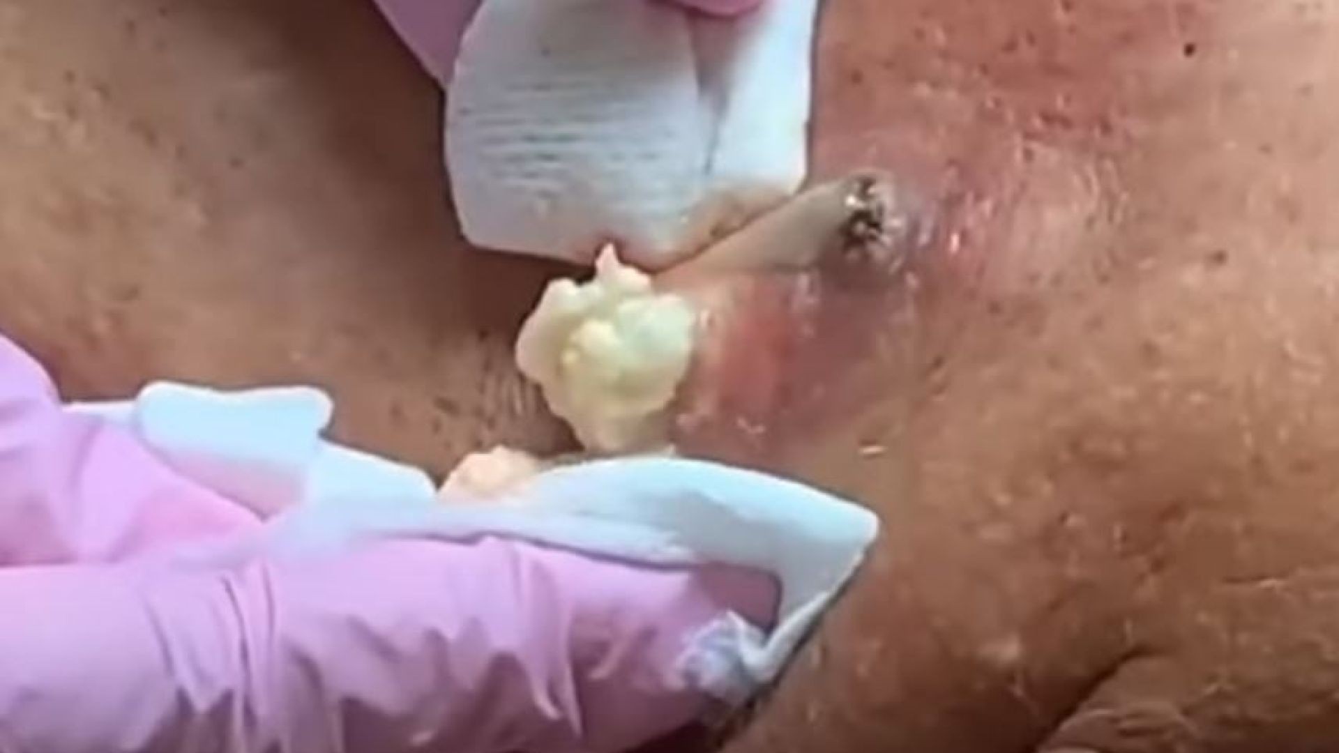 Cyst removal
