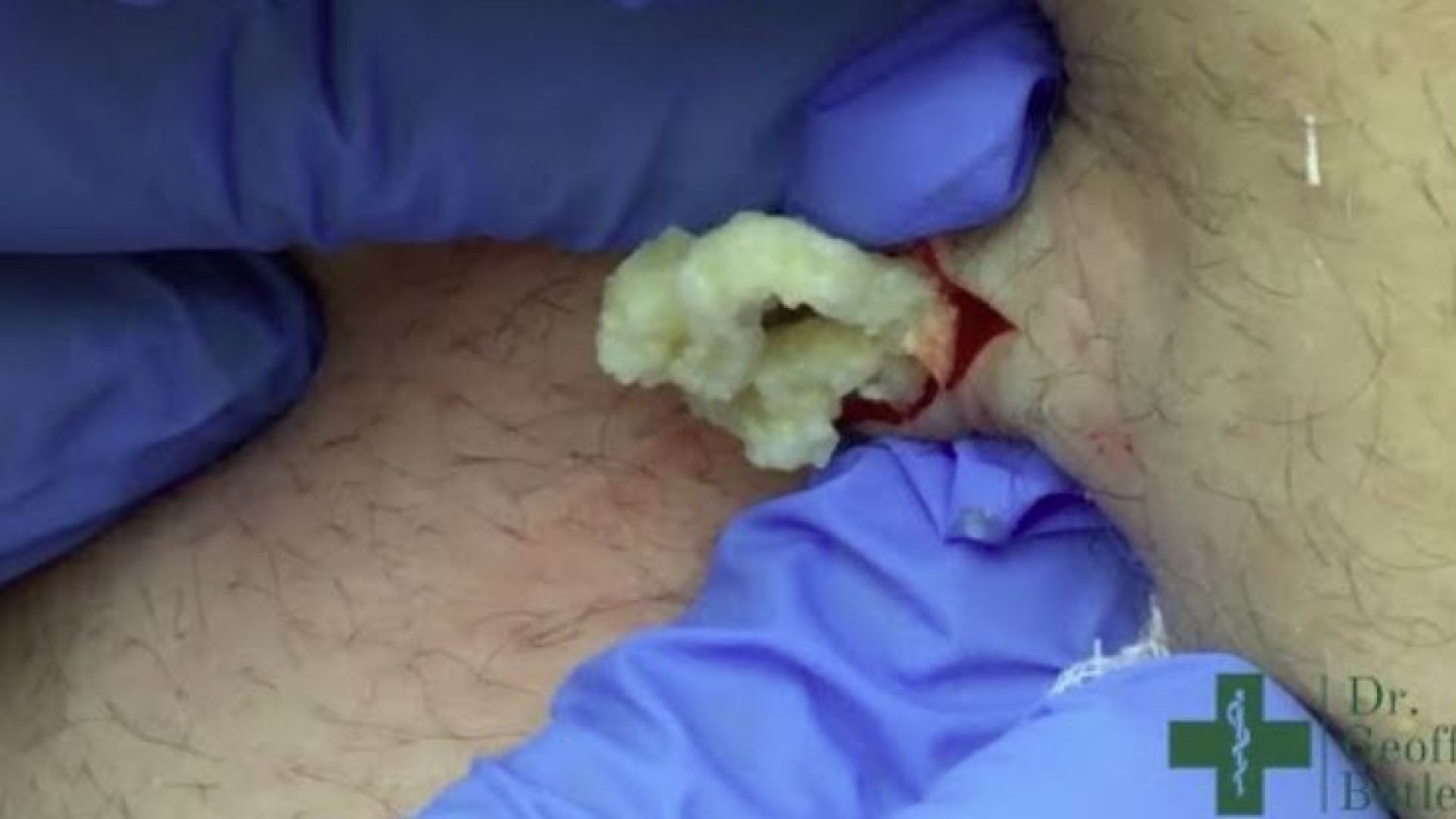 Removal of an Epidermal Cyst on the Lower Back