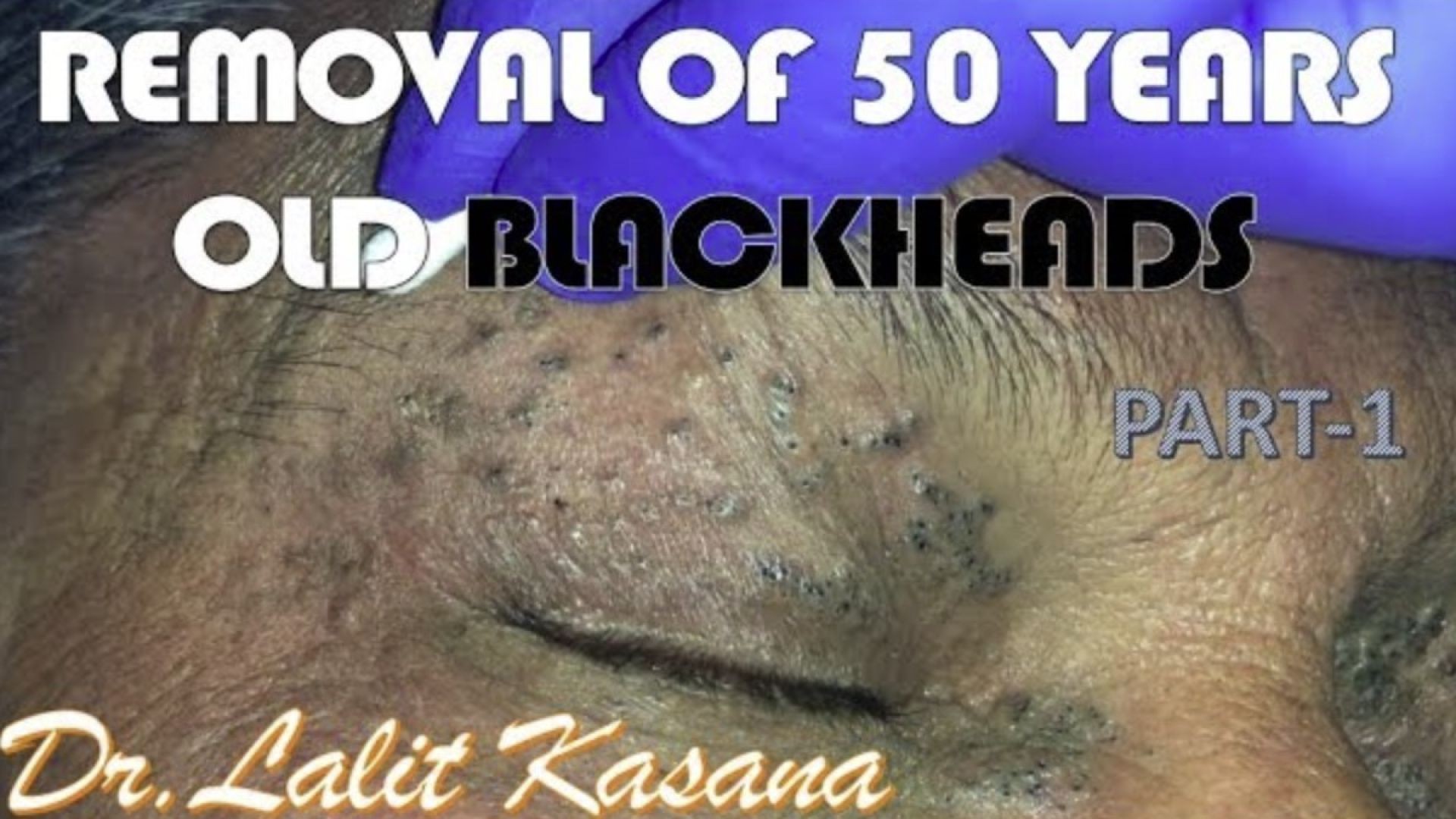 HAVING BLACKHEAD FROM LAST 50 YEARS- REMOVAL BY DR LALIT KASANA