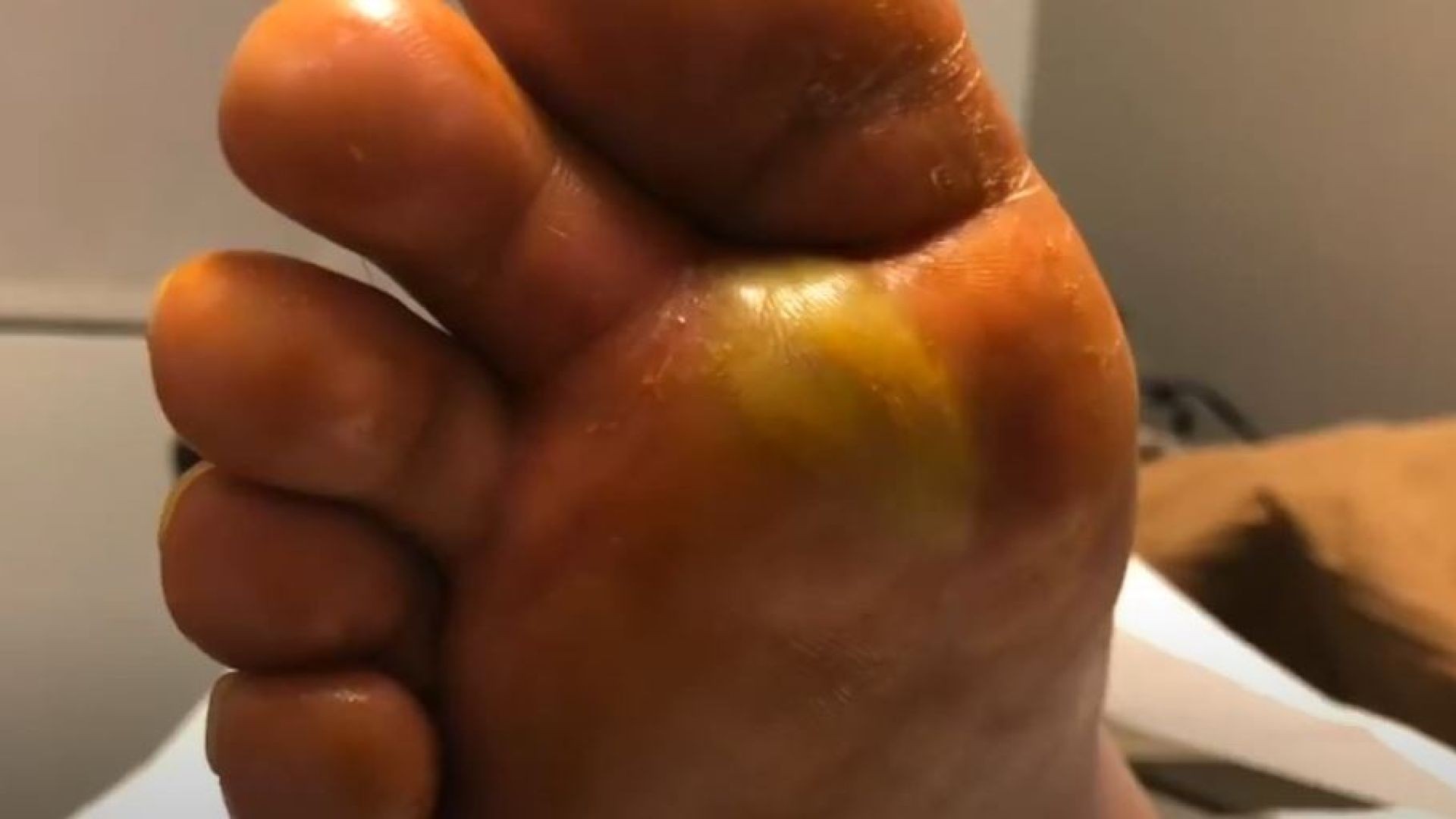 OMG!! Huge Abscess Drain On The Foot!!