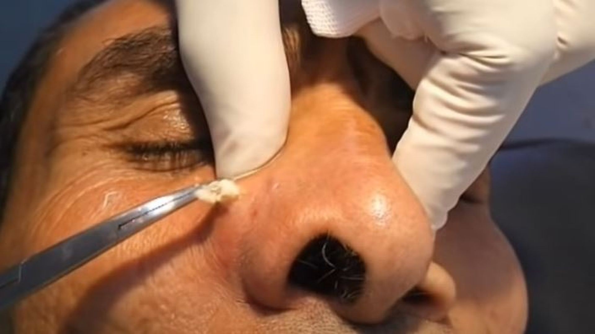 Scar Free  Sebaceous ( Epidermoid ) Cyst Removal.
