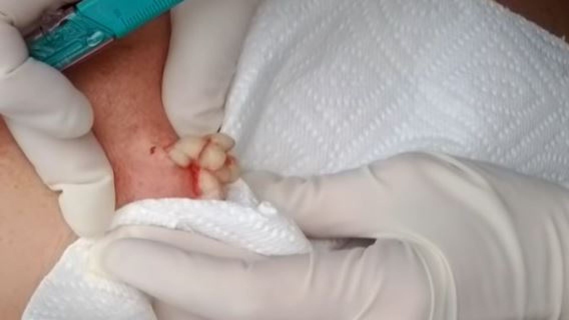 Dan's bodacious  cyst revisited