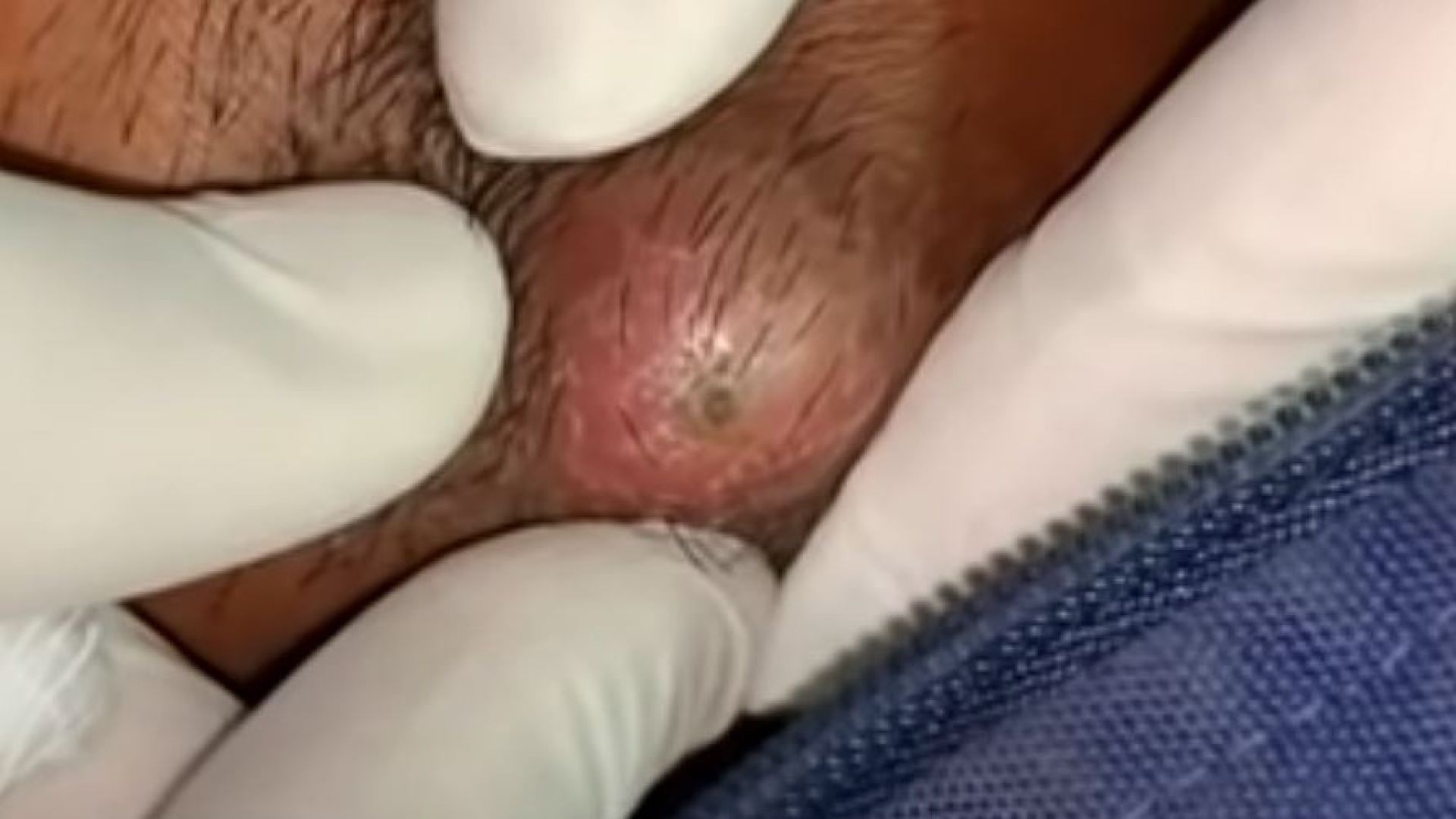 Cyst boil popping
