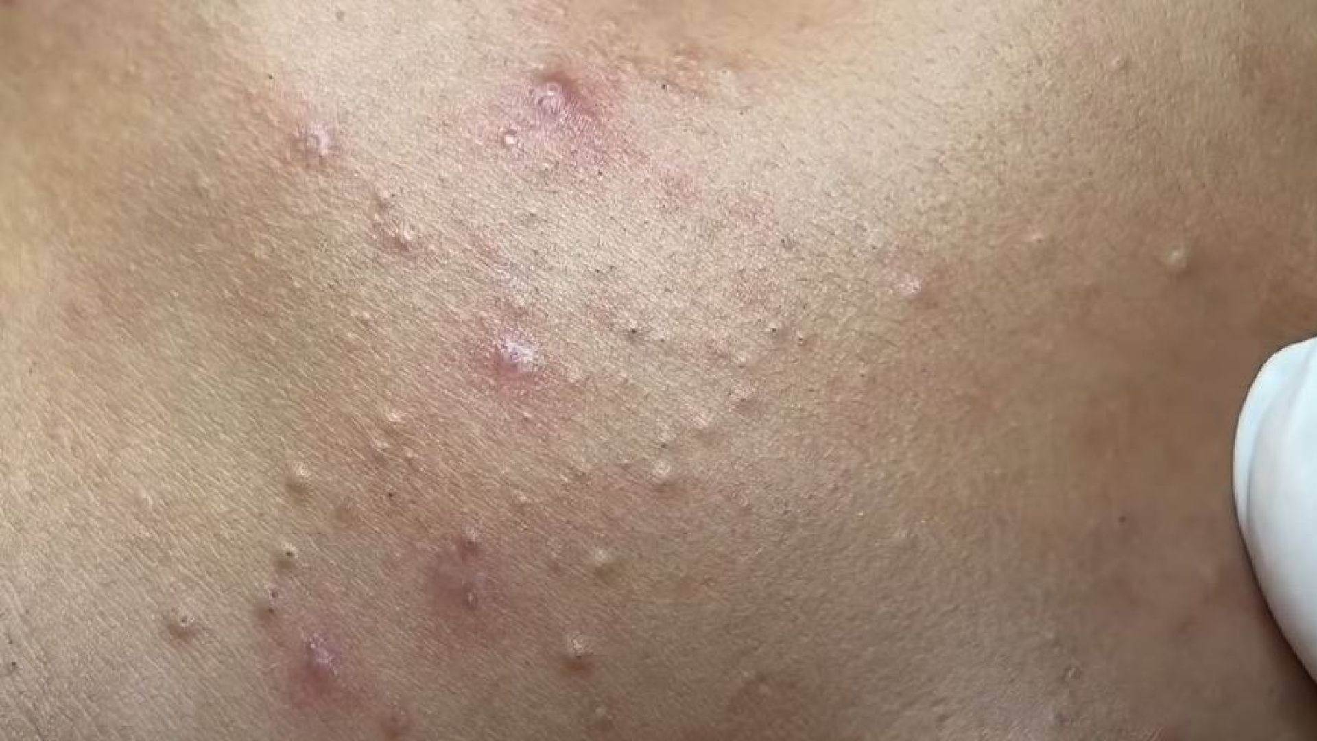 Blackhead and Fat Acne On Neck and Face