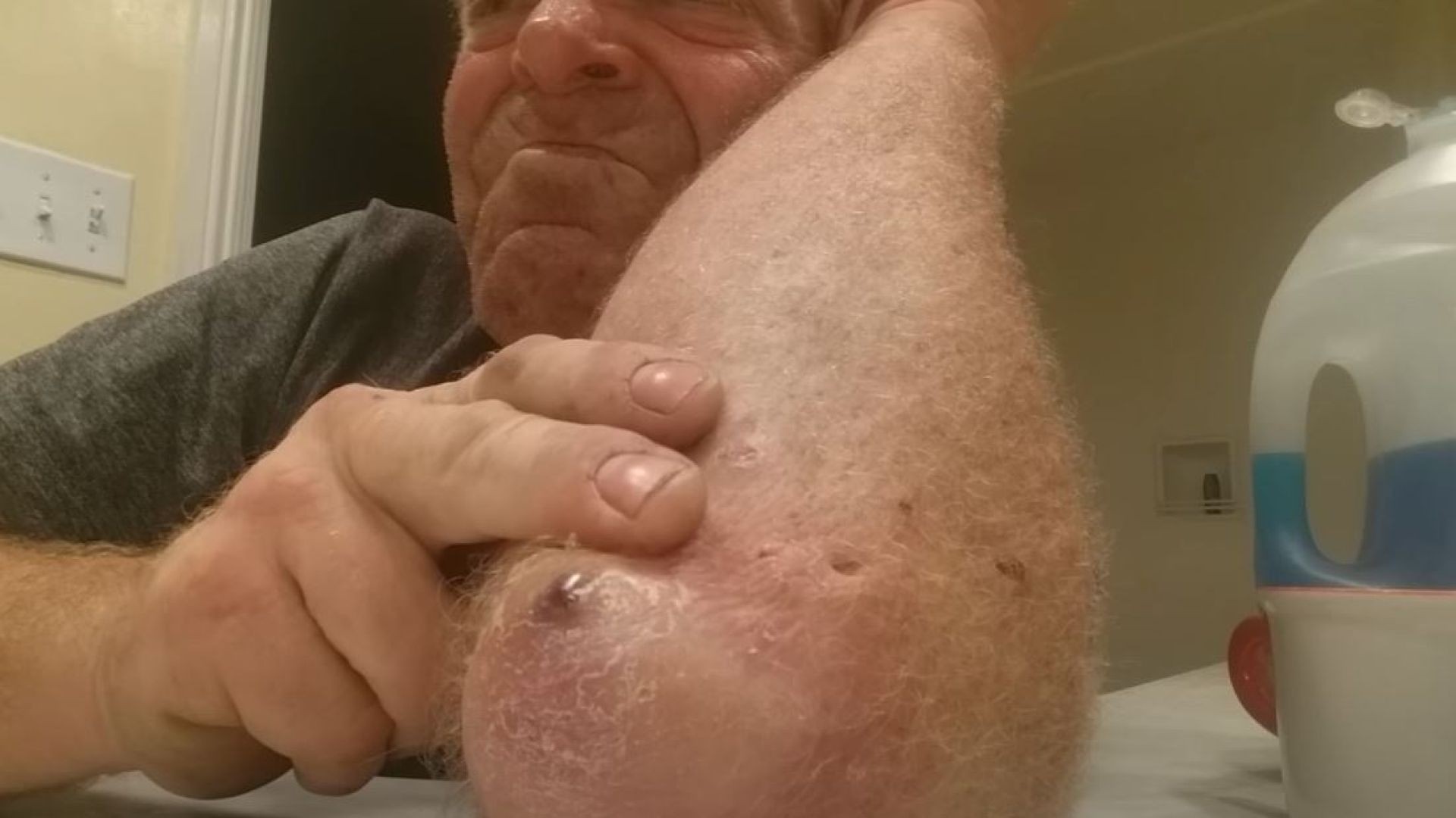 Crazed ginger squirtes cyst out of elbow 1of2