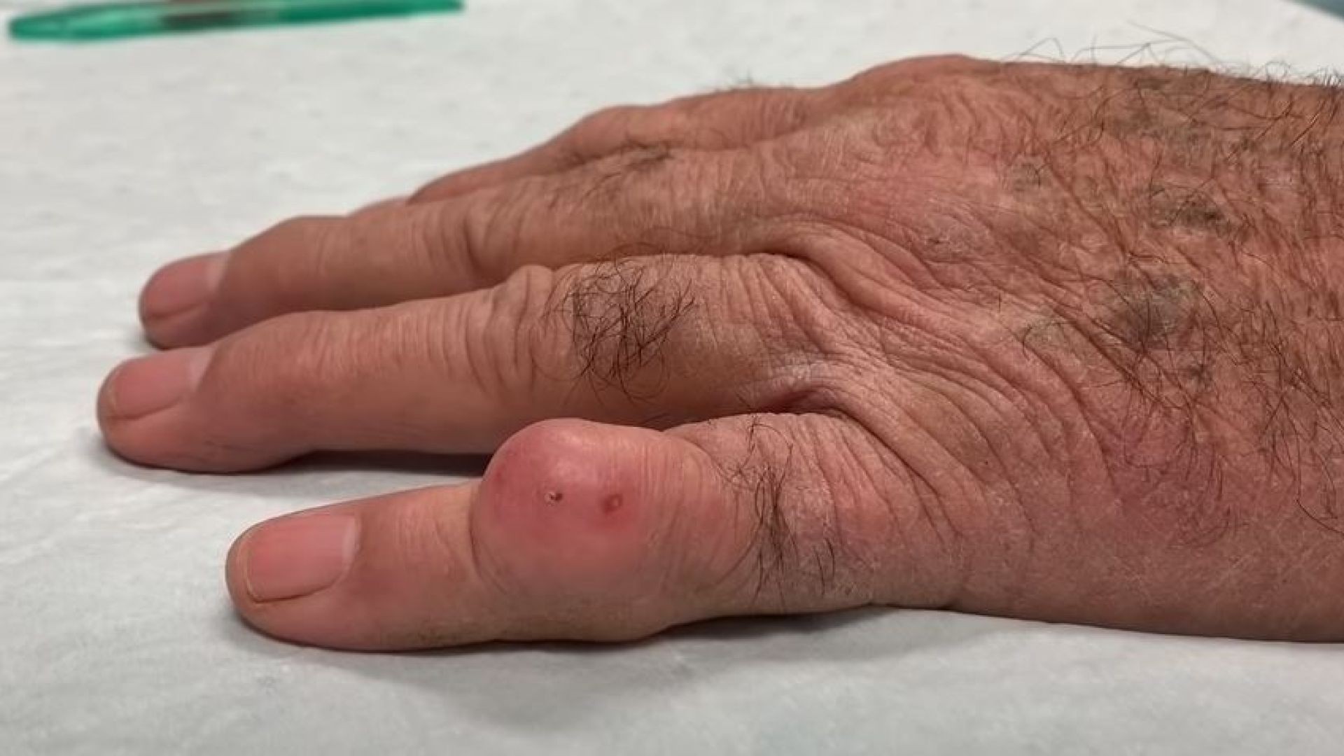Inclusion cyst in the finger