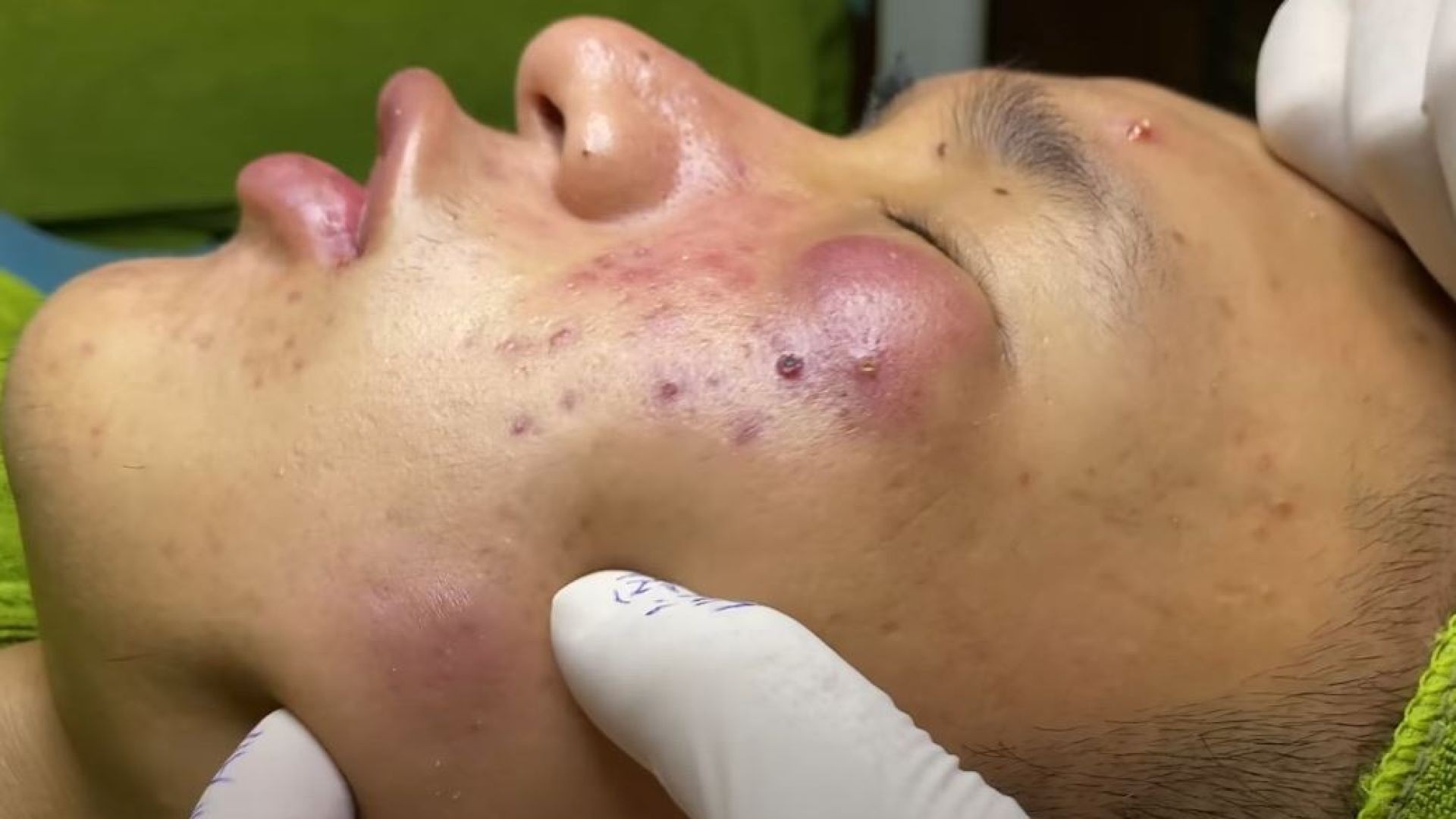 Infected cyst on the face