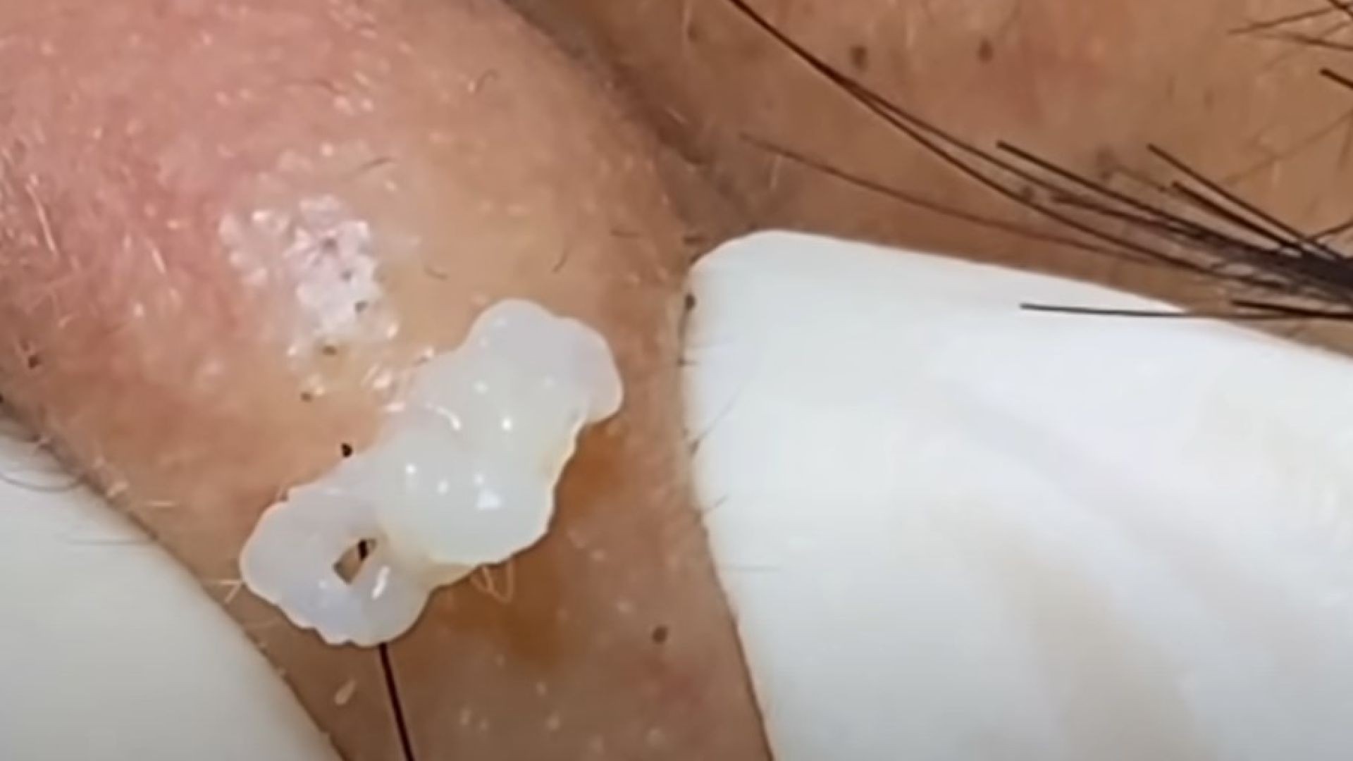 Spazieren gehen anwendung ihre pimple bursts bevorzugen gummi wette