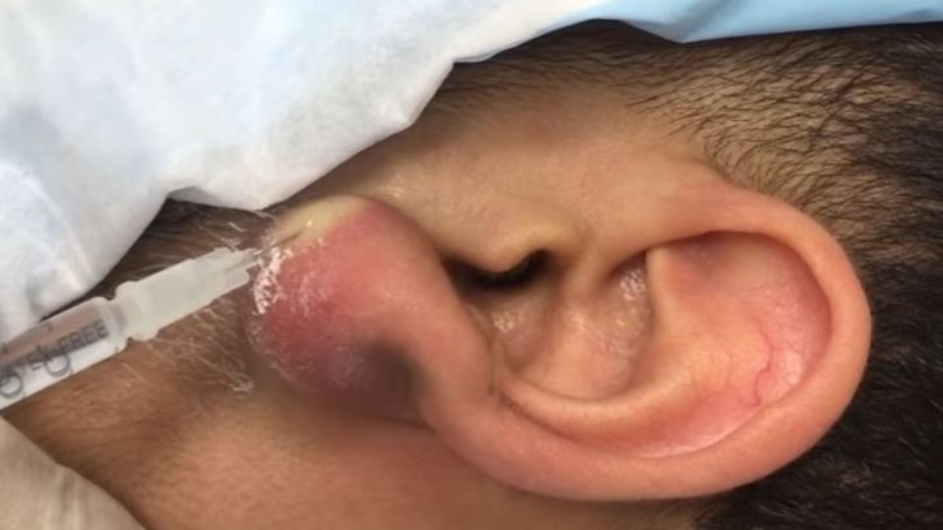Giant Pus-Filled Earlobe Redux with Comments!