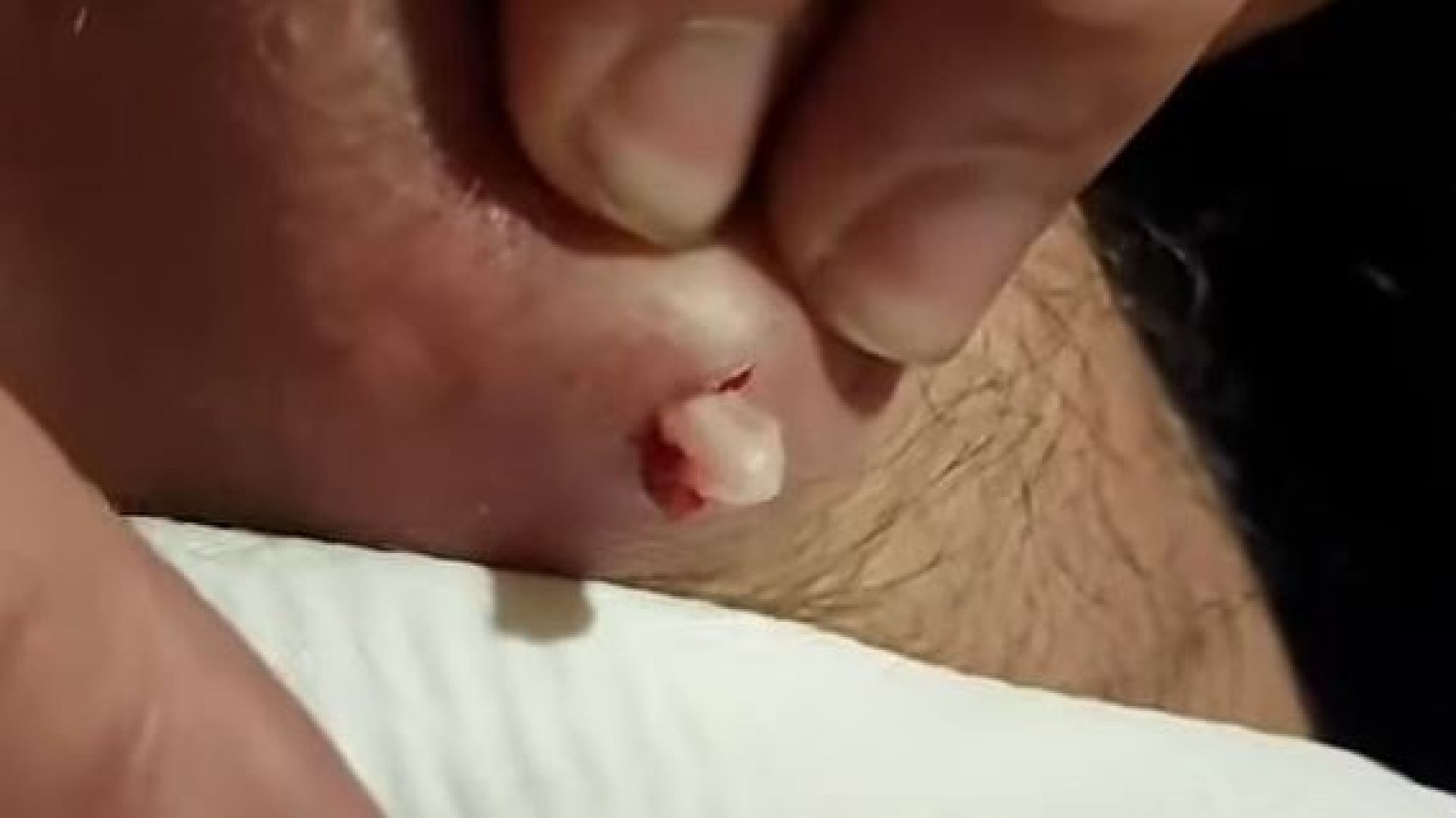 Lumpy Cyst of Knee Popping - Explosive !!