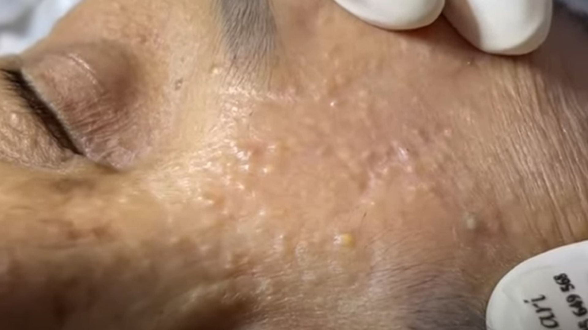 Super Relax with Yellow Fat Acne in the Elderly
