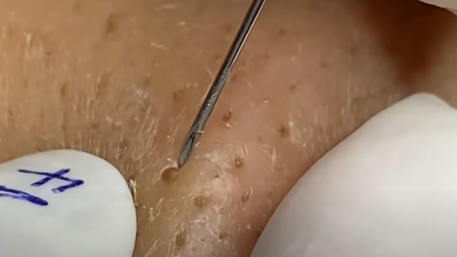 Loan nguyen pimple