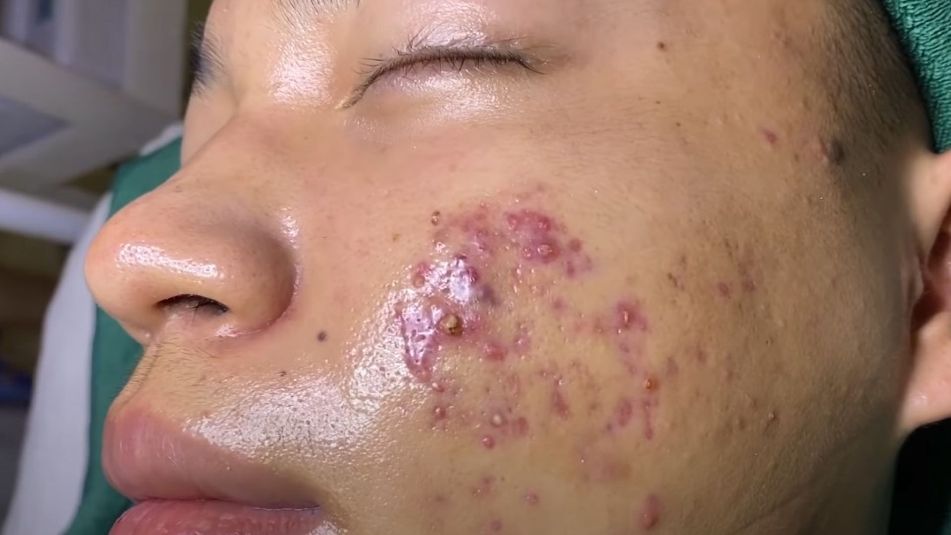 Overcome the Consequences of Wrong Acne Treatment