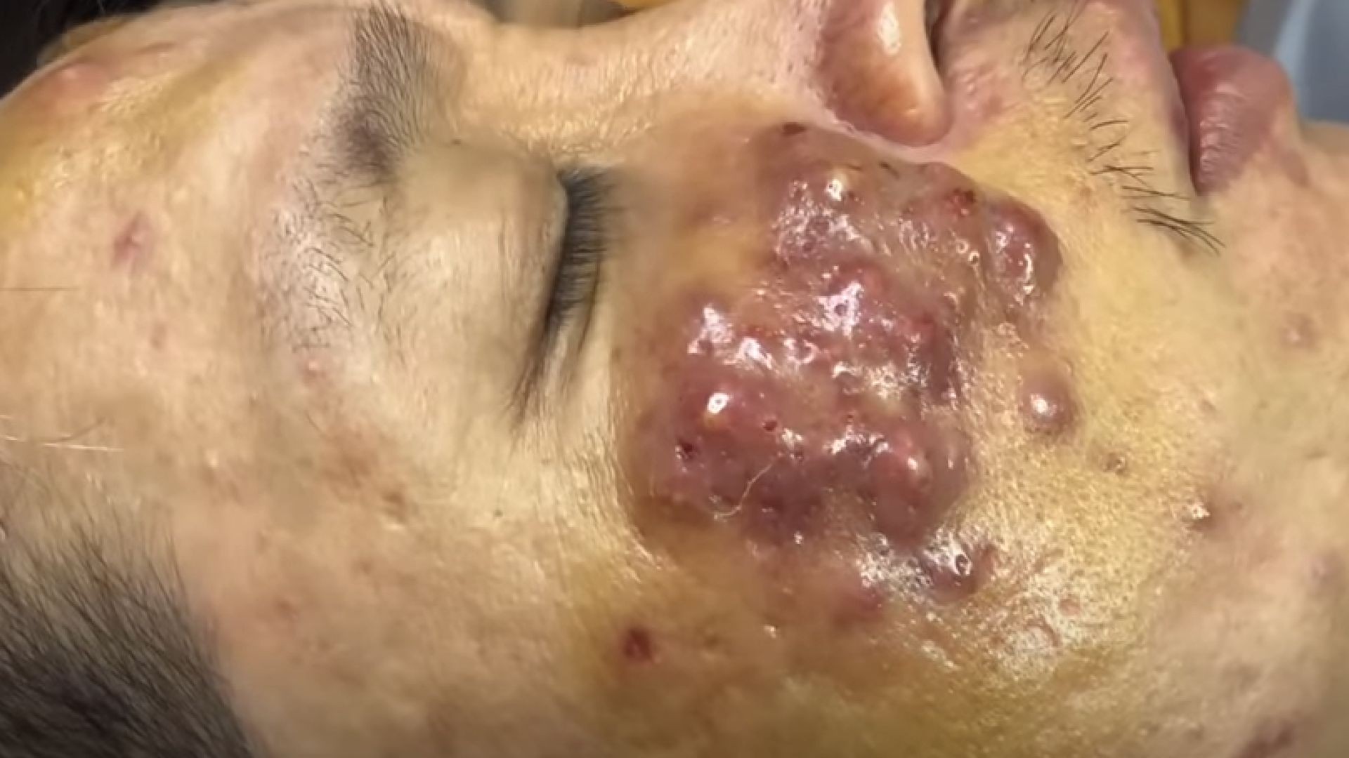 Relax Everyday with Blackheads & Acne Treatment 04