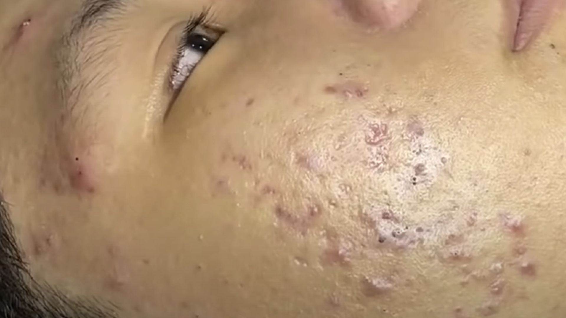 TREATMENT OF BIG BLACKHEADS AND HIDDEN ACNE IN THE FACE
