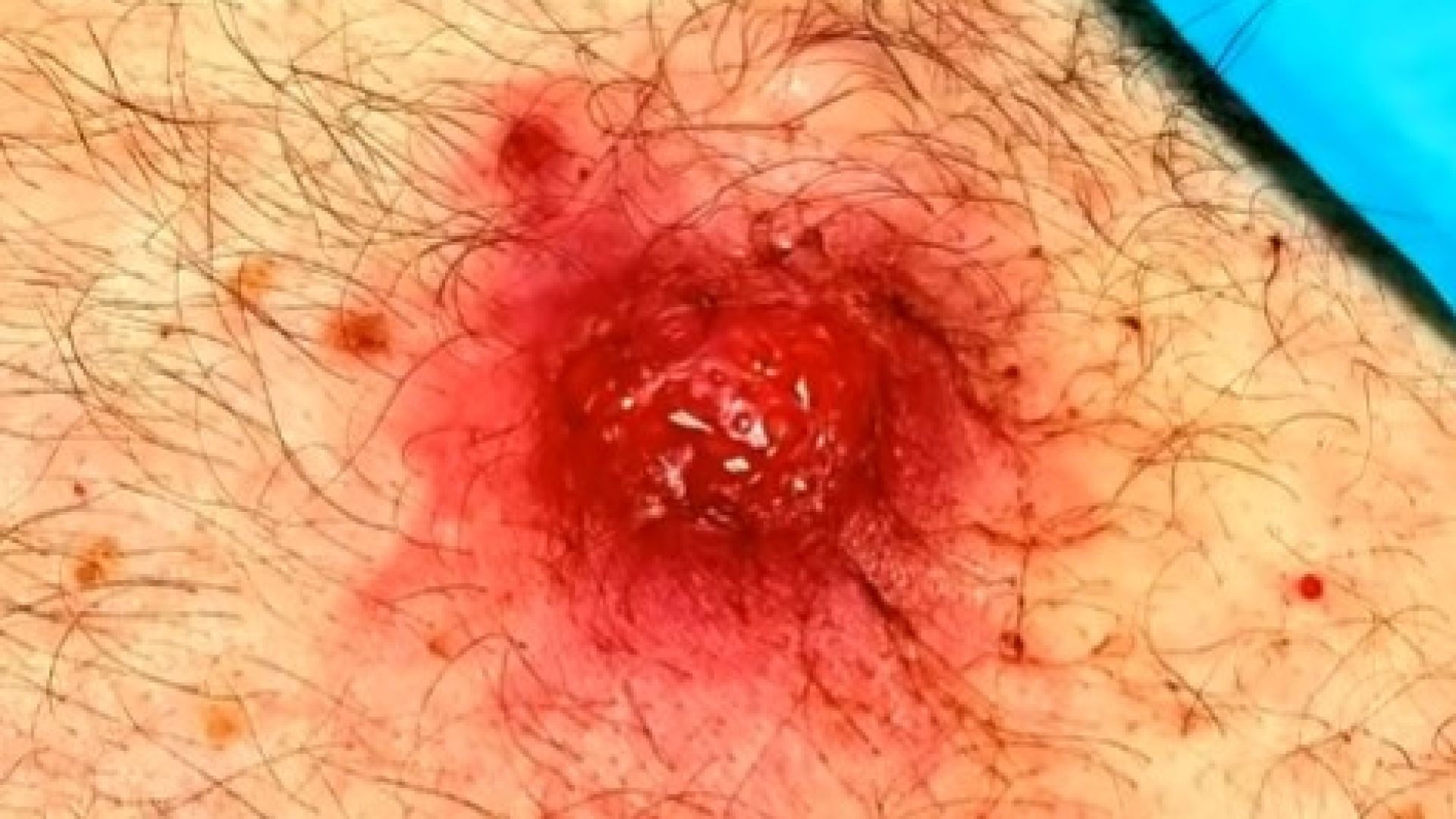 Peeling and popping a big absces shorts dermatologist