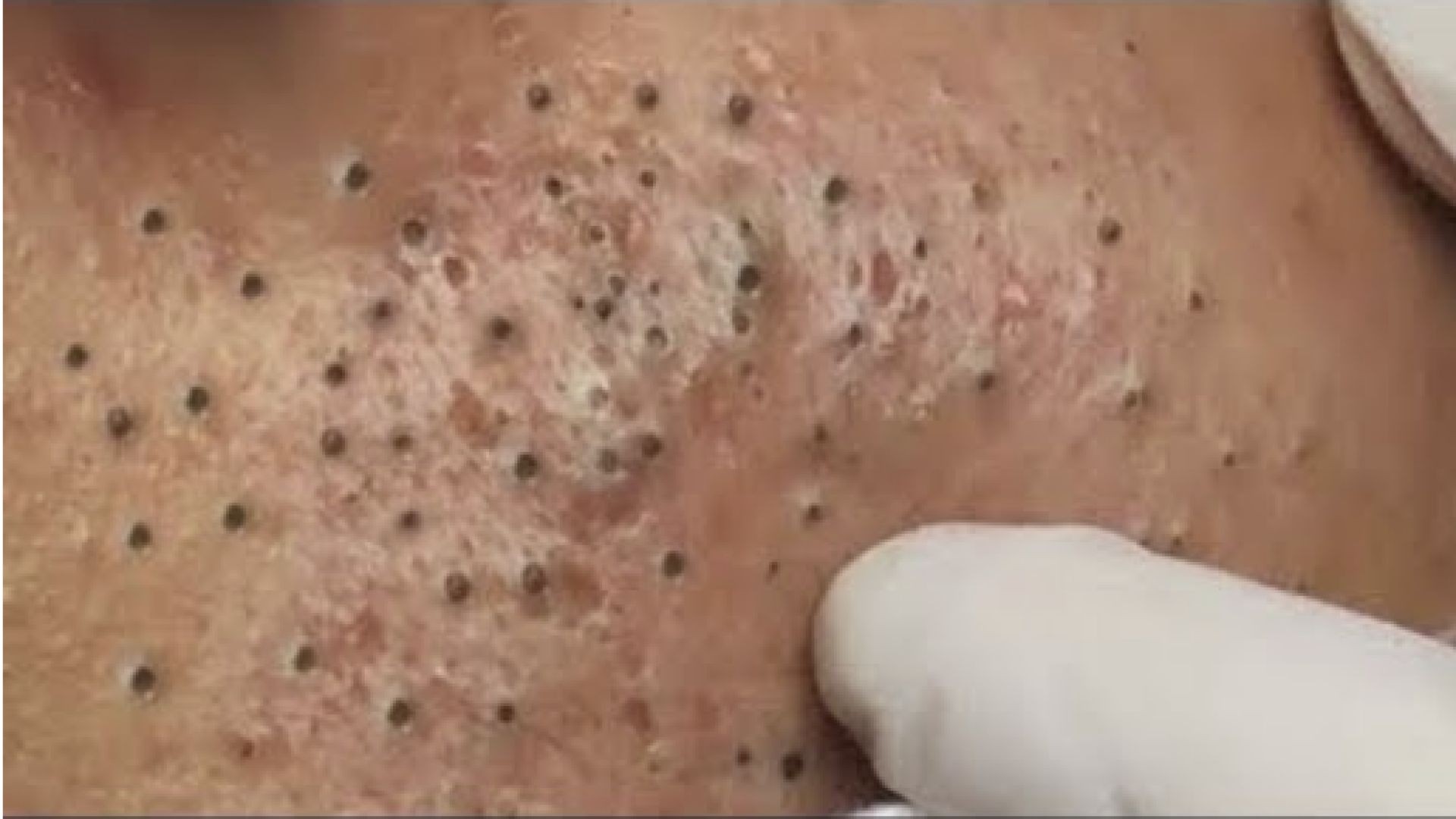 relaxing blackheads removal pimple popping videos blackheads removal large blackheads popping