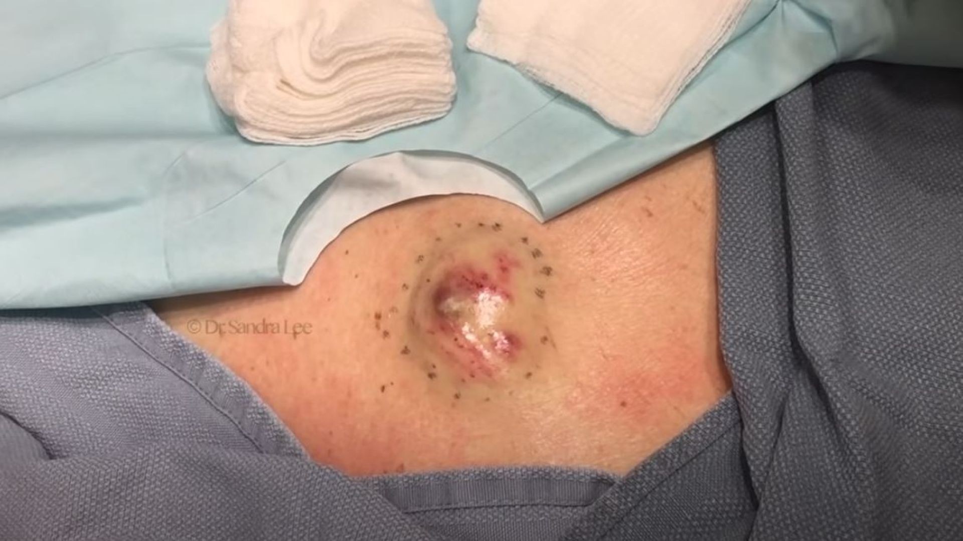 Cyst on back removal