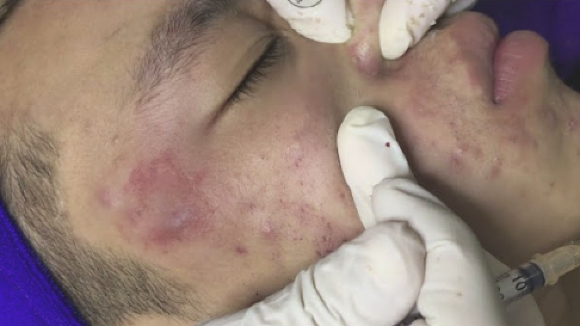 Acne treatment under the skin #008 / Spa Linh Mun