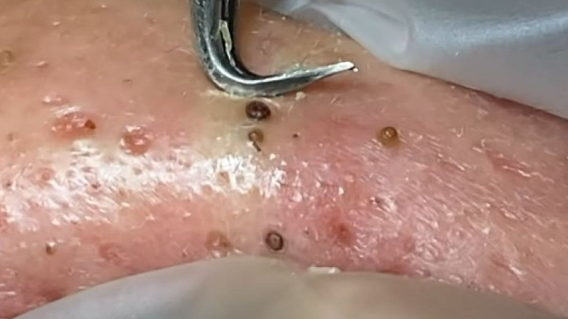 Get Overwhelmed with This Blackhead Extraction
