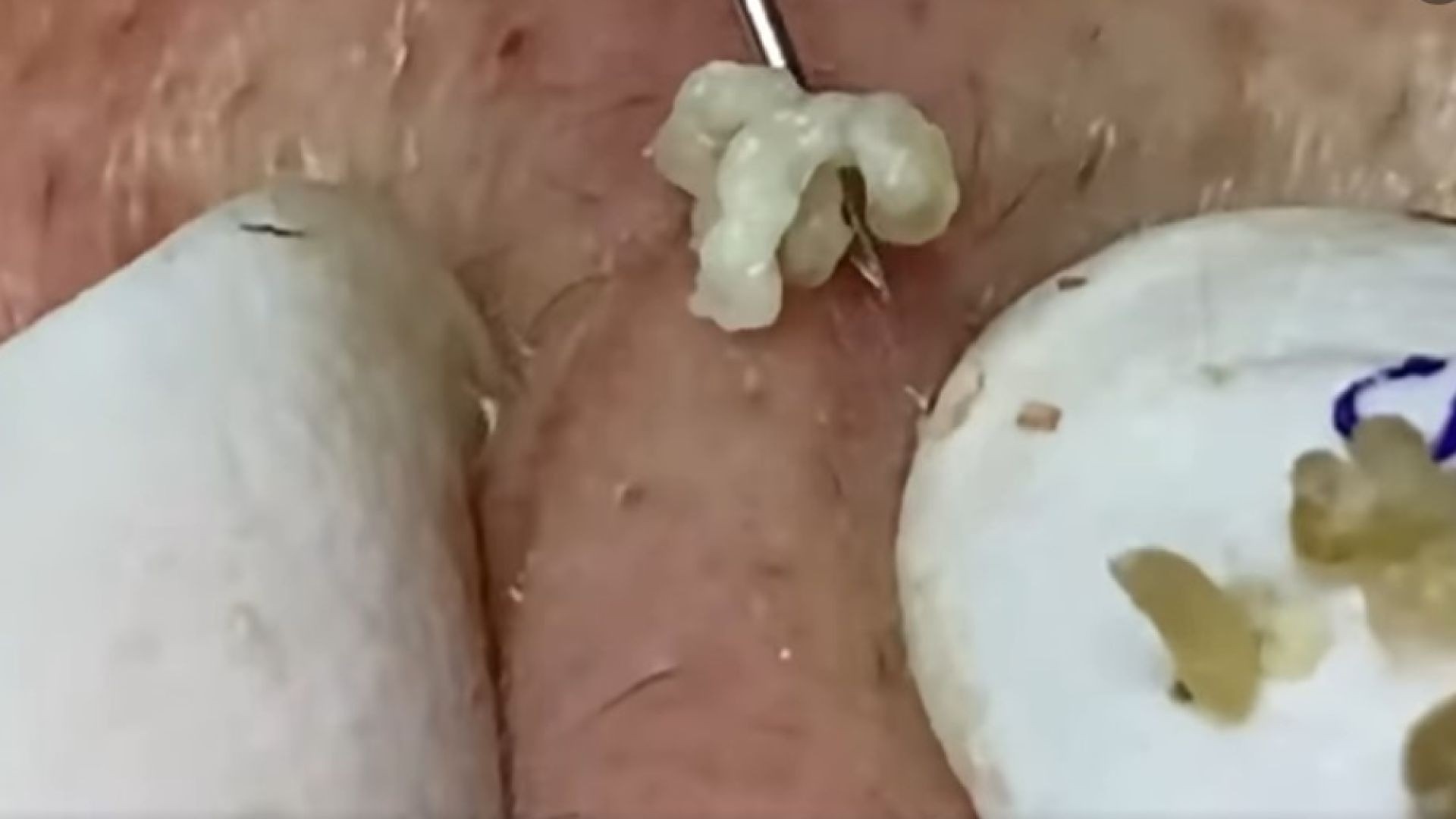 Best blackheads removal (313-2) | Loan Nguyen
