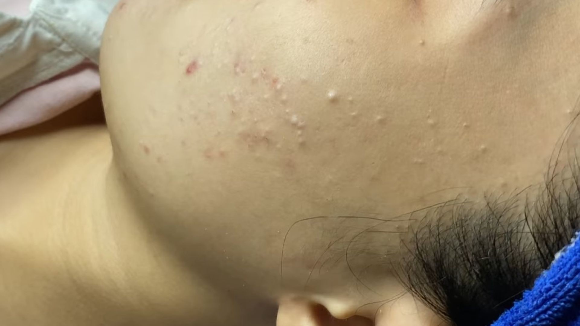 Extractions And Acne - ThuyTruong#86