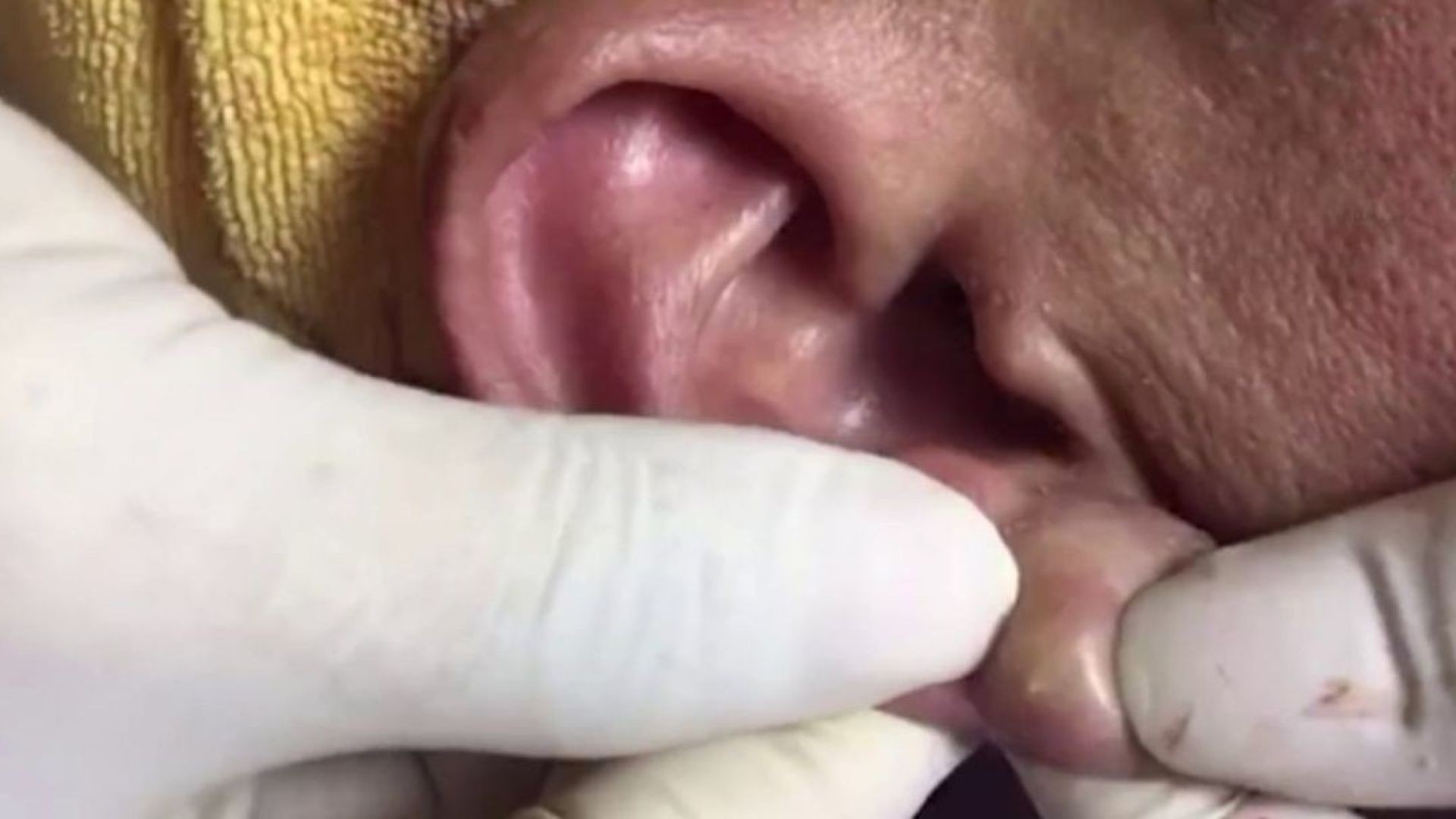 Must see this beautiful ear cyst removal
