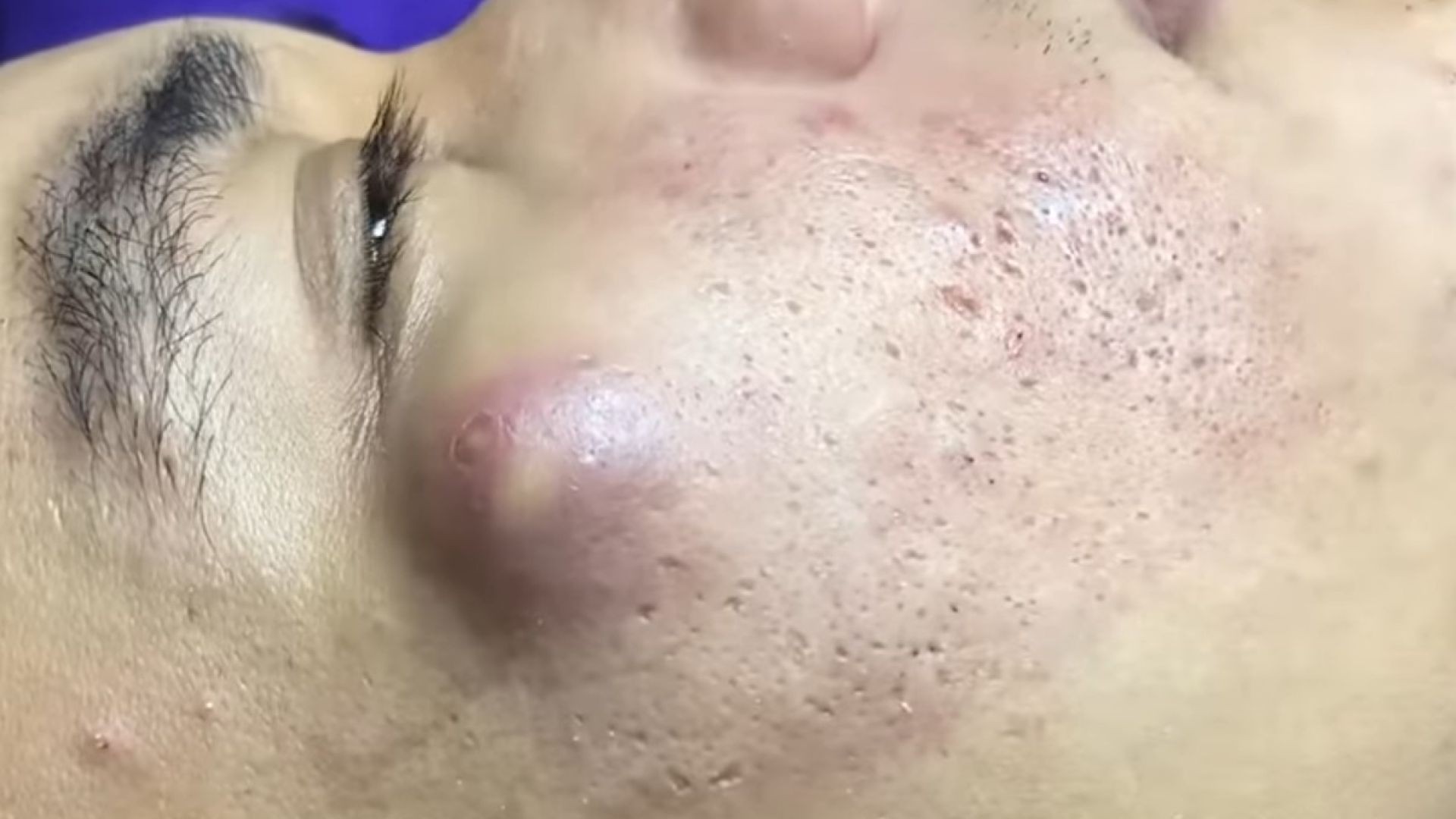 Removing large cysts for boys and whiteheads extraction (233) | Loan Nguyen