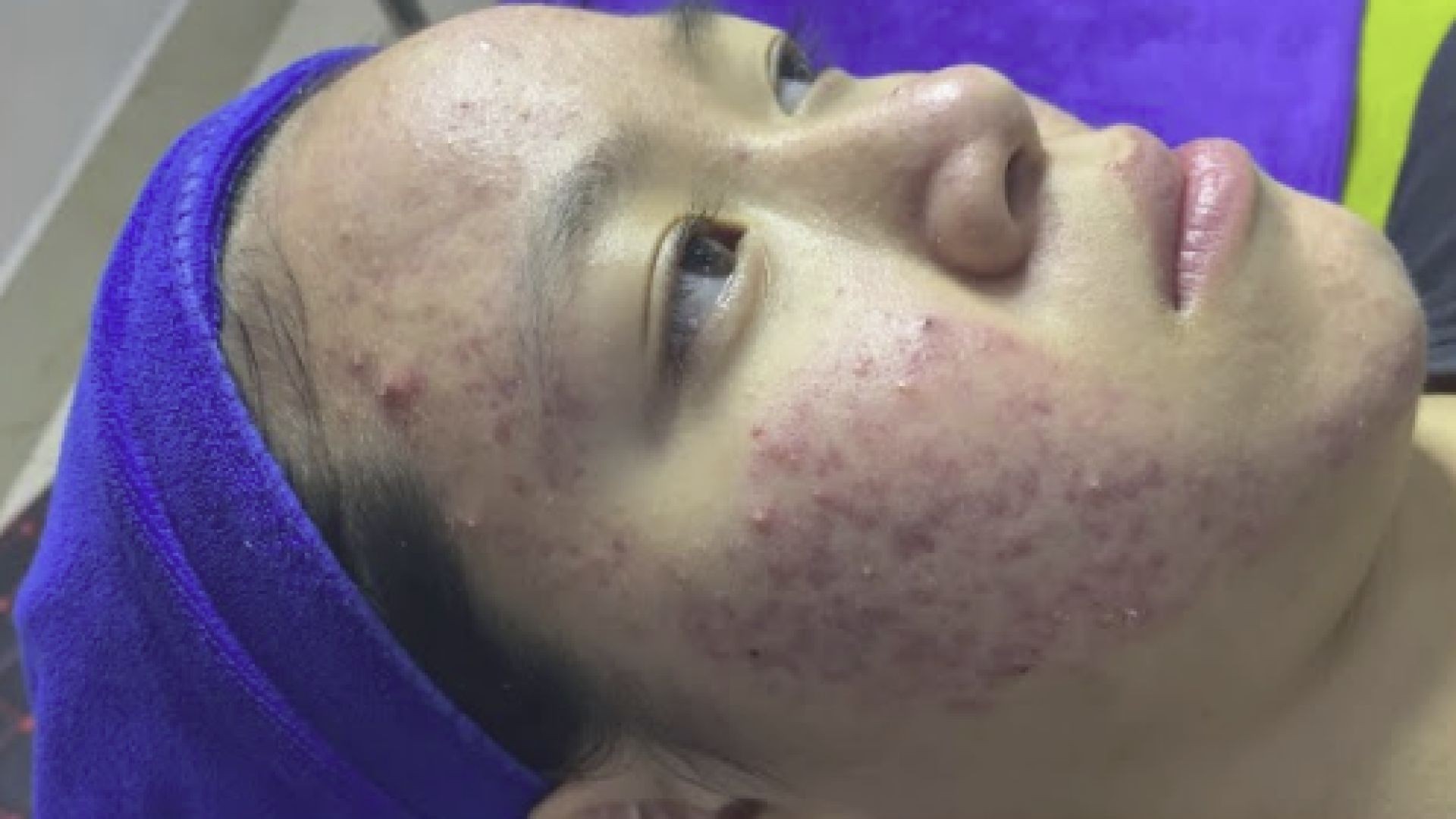 Acne treatment under the skin #015 / Spa Linh Mun