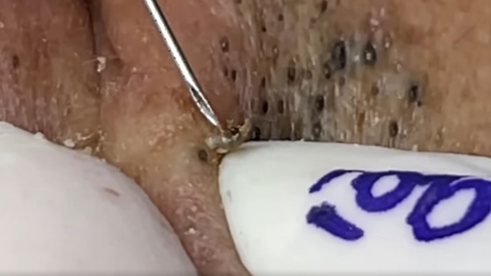 Satisfying Blackhead Removal of Monster-Size on Face