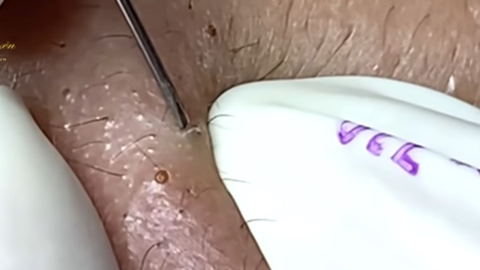 Full screen tiny blackhead removal with endless content