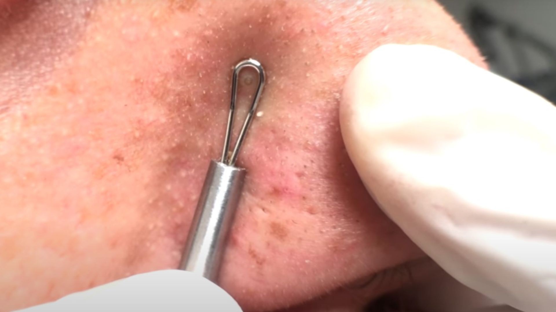 Nose Blackhead and Some Others
