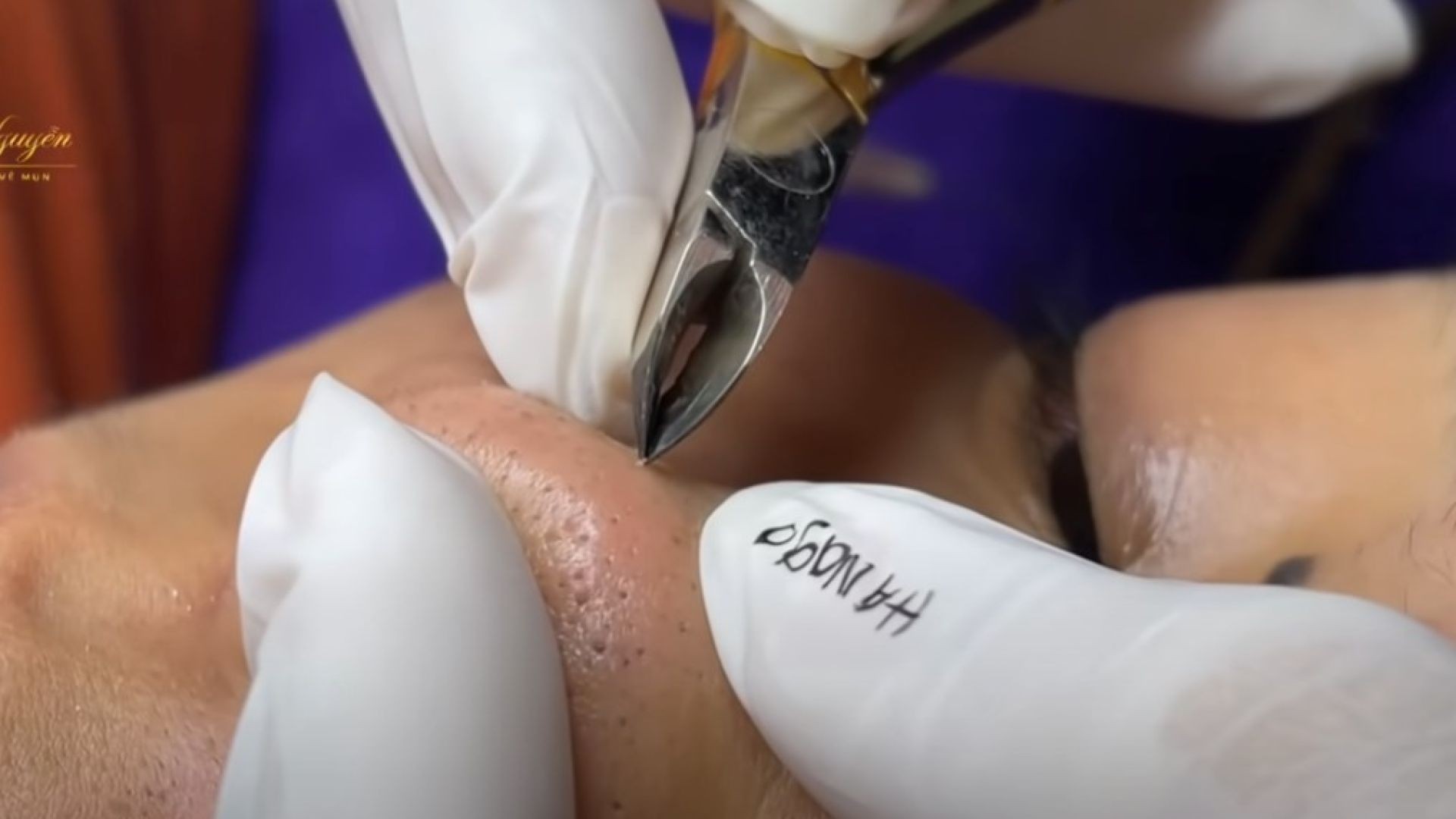 Blackhead Pulling out