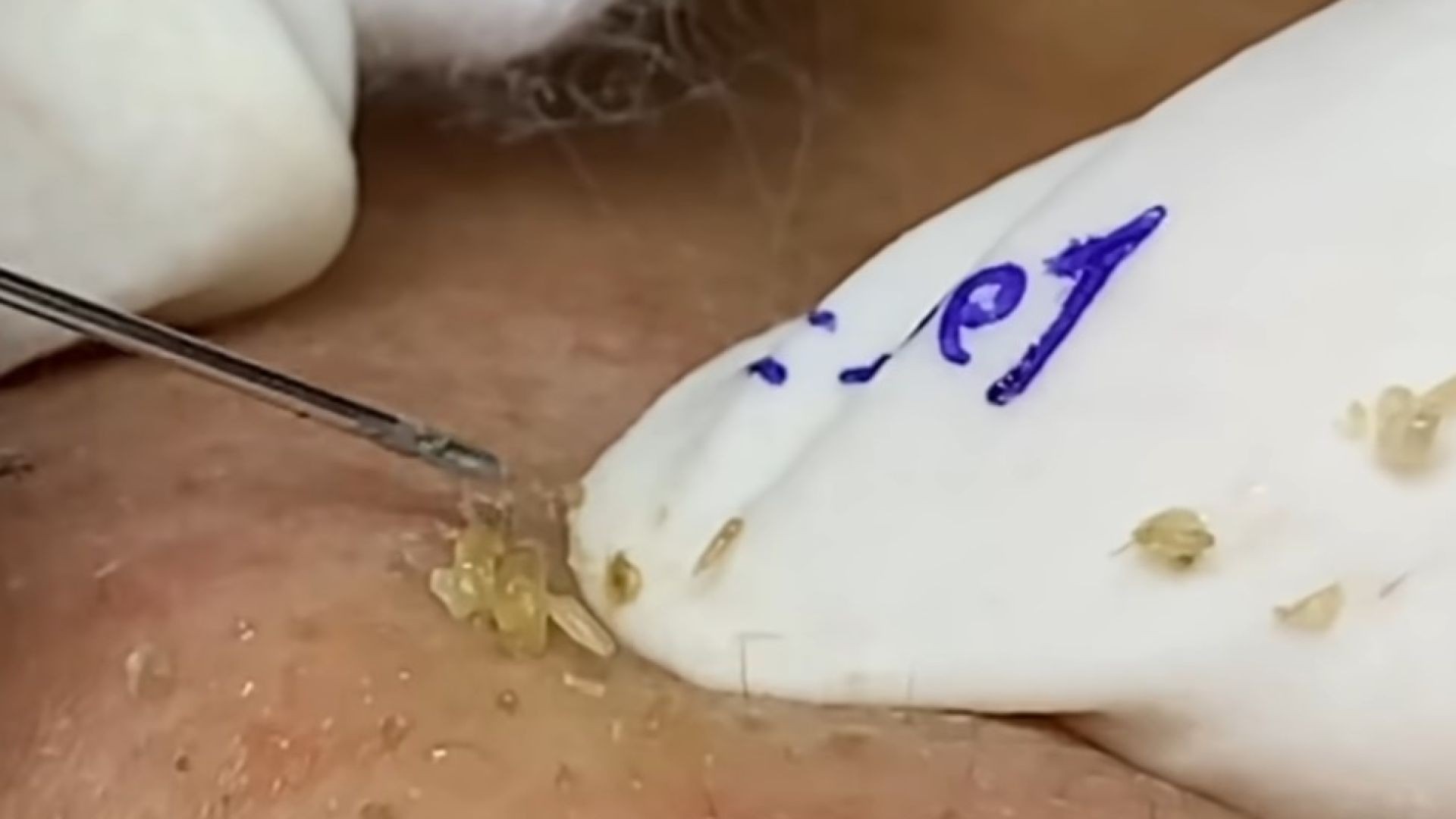 REMOVAL BLACKHEADS (75) | Loan Nguyen